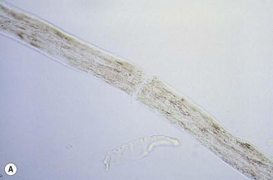 Figure 31.8, (A) Trichoschisis in trichothiodystrophy. Light microscopic appearance. (B) ‘Tiger tail’ appearance of light and dark bands on polarizing microscopy of hair in trichothiodystrophy.