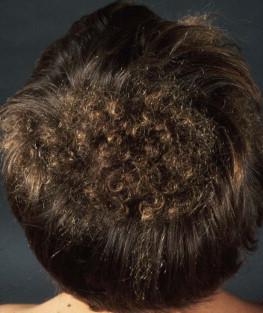Figure 31.9, Woolly hair.
