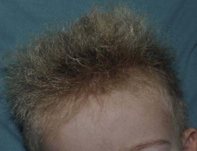 Figure 31.10, Uncombable hair.