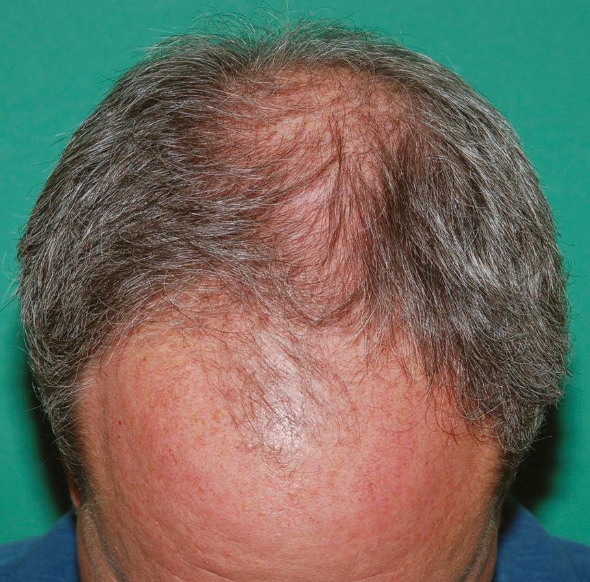 Fig. 22.2, Androgenetic alopecia in men commonly begins with thinning in the frontotemporal recessions and crown regions. Thinning progresses with age to further thin the frontal forelock, midscalp, and peripheral crown regions.