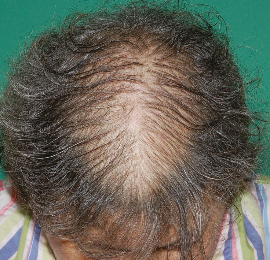Fig. 22.3, Androgenetic alopecia in women most often presents with diffuse central scalp thinning and an intact frontal hairline.
