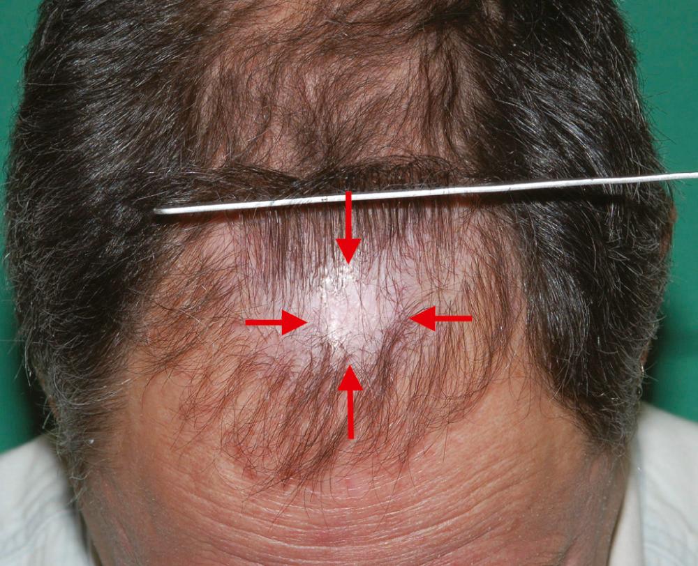 Fig. 22.4, Cicatricial scarring (area enclosed by arrows ) is characterized by shiny white skin with complete loss of follicular openings.