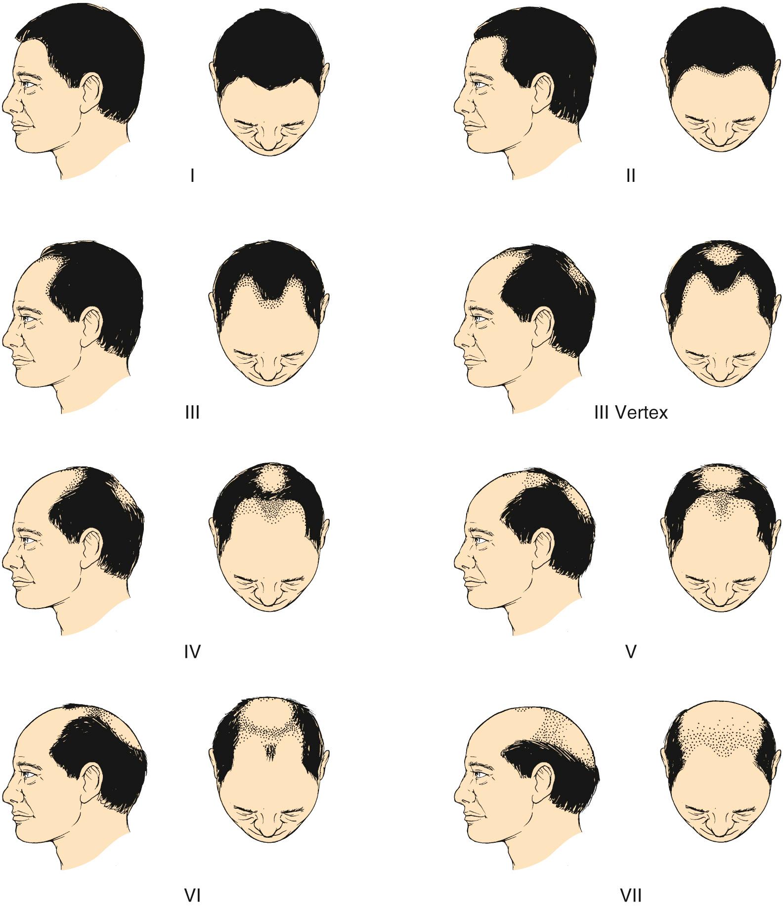 Fig. 22.5, Norwood classification system of male pattern baldness.