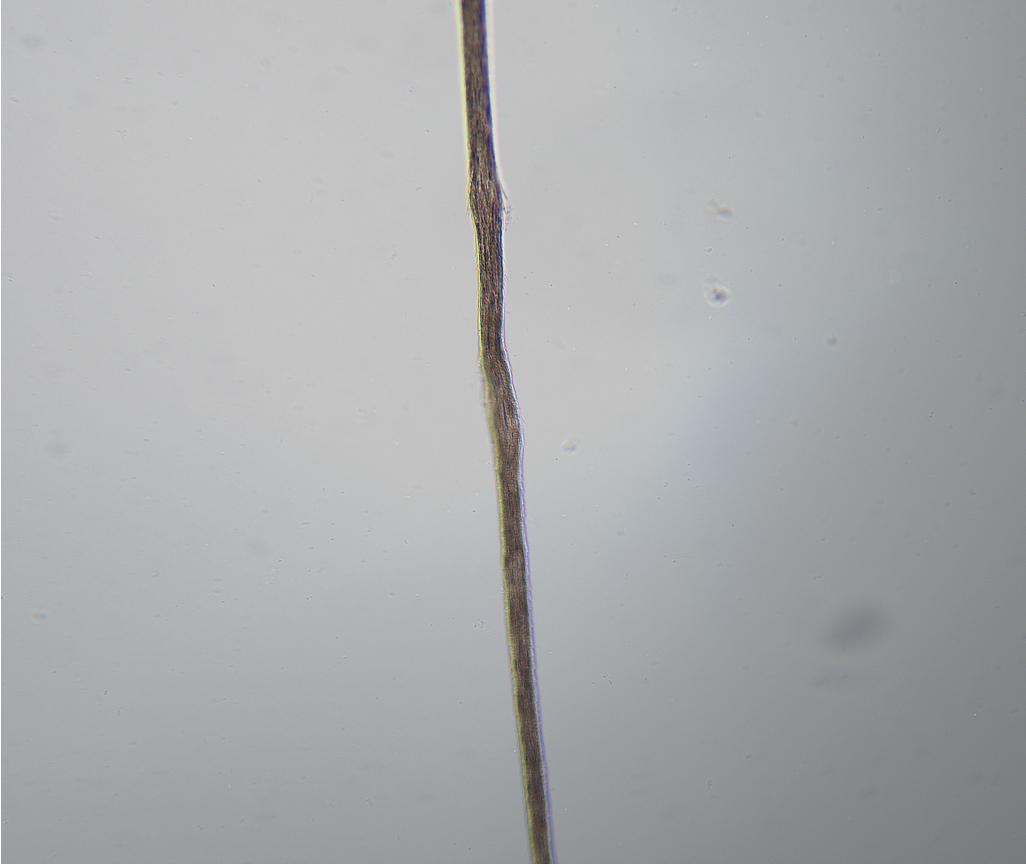 Fig. 5.2, Trichorrhexis nodosa in a female of African descent with nonbleached hair.