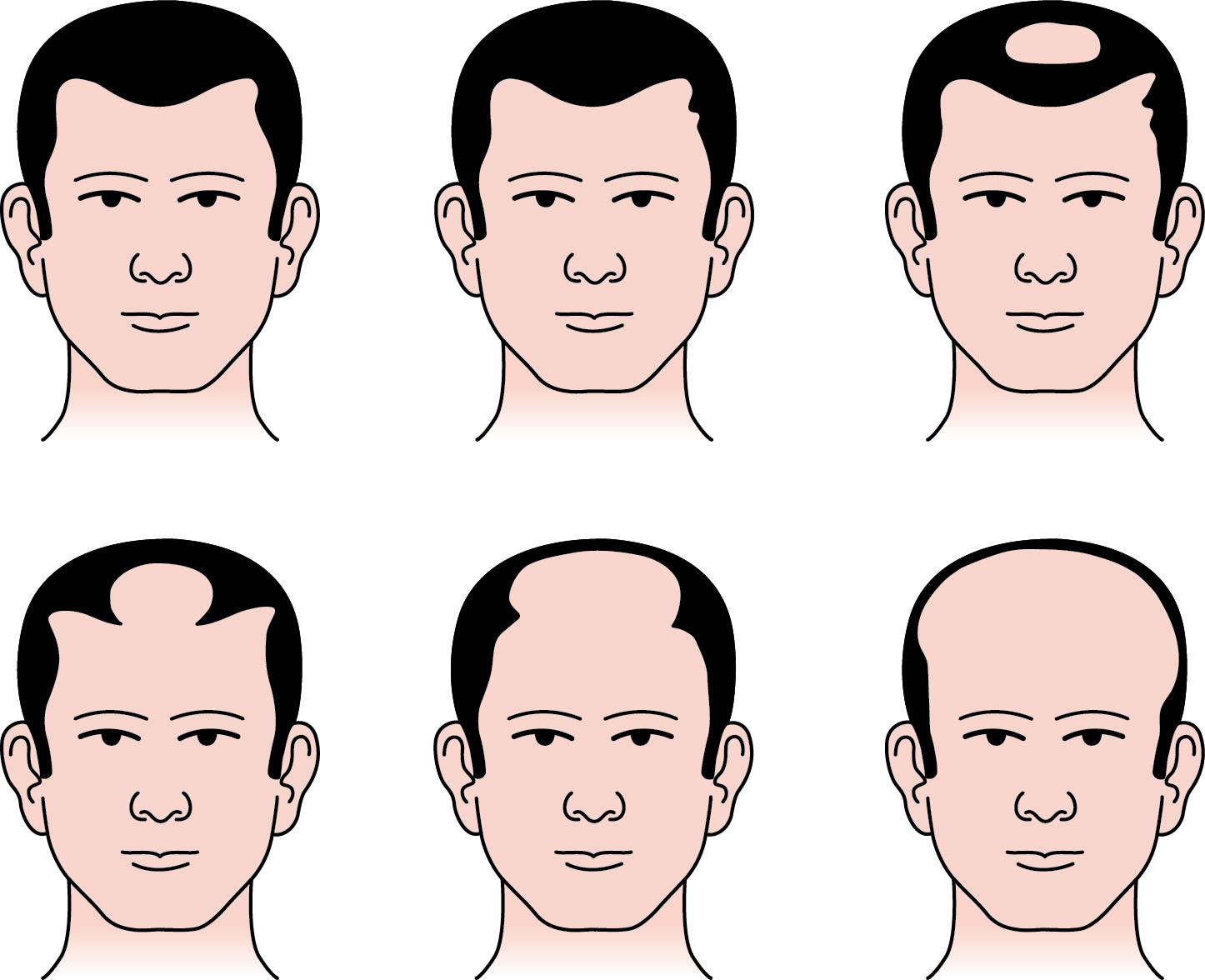 Fig. 9.3, Androgenetic alopecia: patterns of hair loss in males (Hamilton Norwood grading)