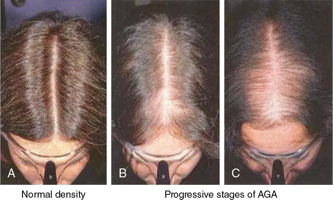 Fig. 9.4, Hair loss pattern showing the Ludwig classification for female alopecia