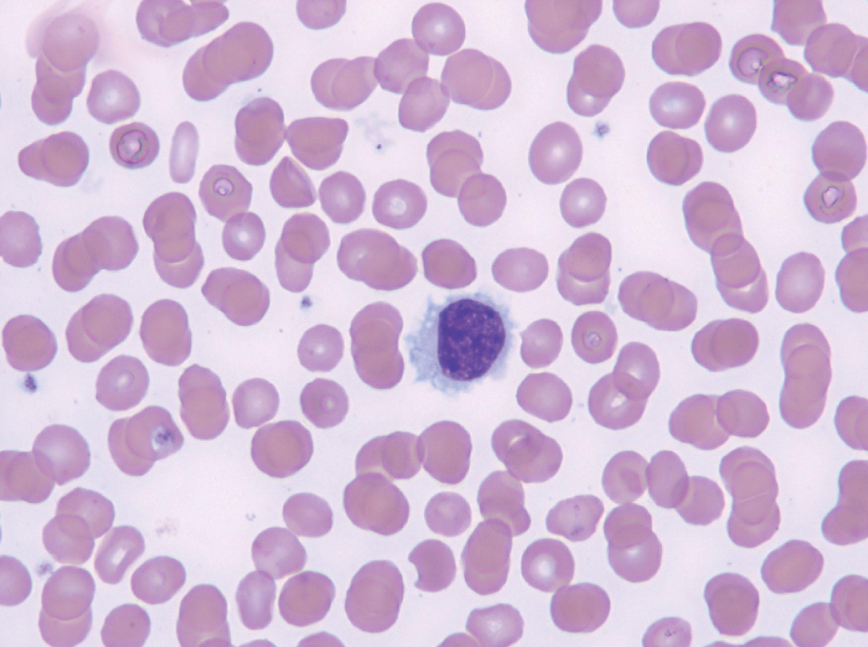 Figure 77.2, PHOTOMICROGRAPH OF A HAIRY CELL IN THE PERIPHERAL BLOOD.