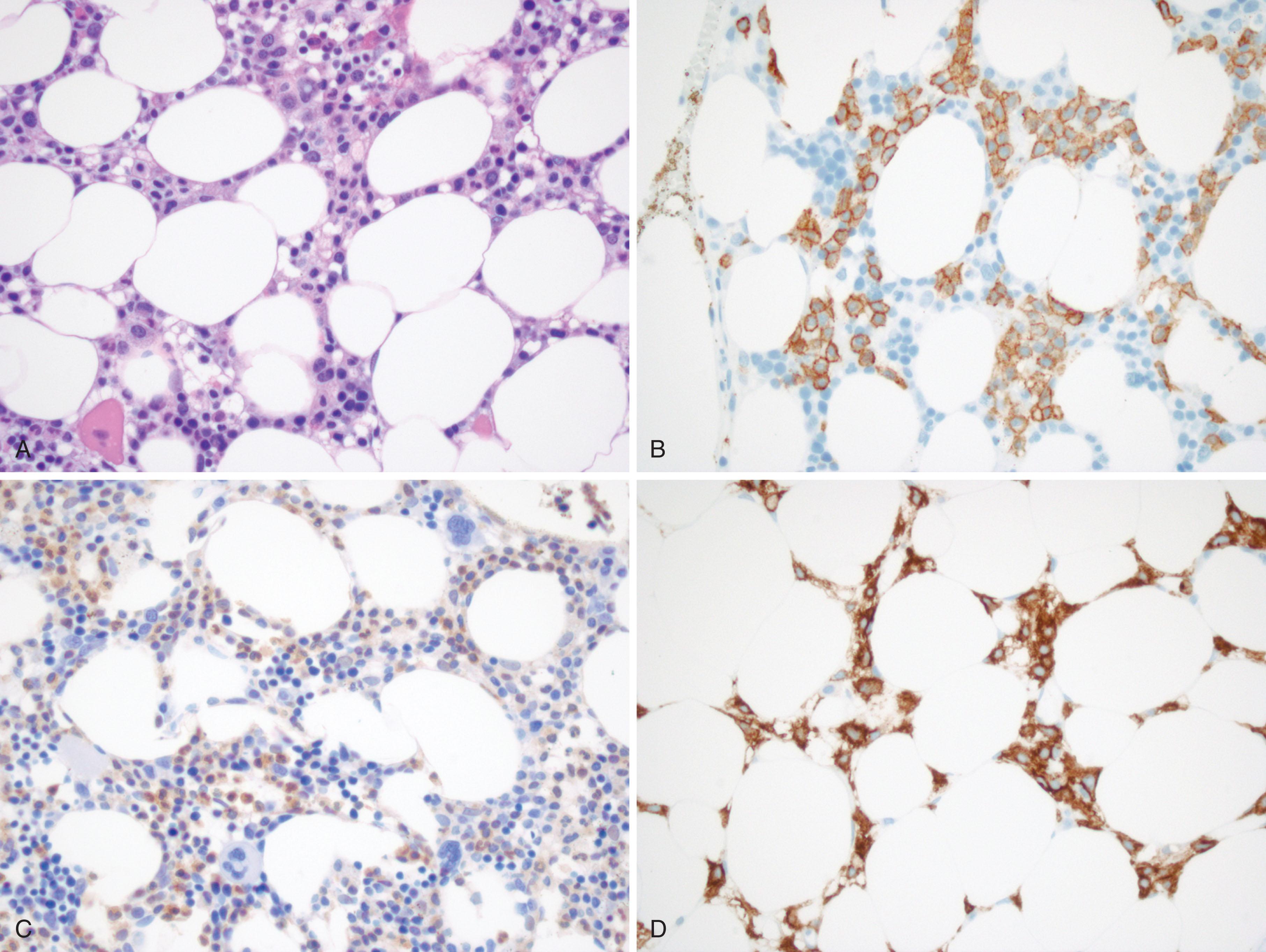 Figure 77.4, BONE MARROW FINDINGS IN HAIRY CELL LEUKEMIA.