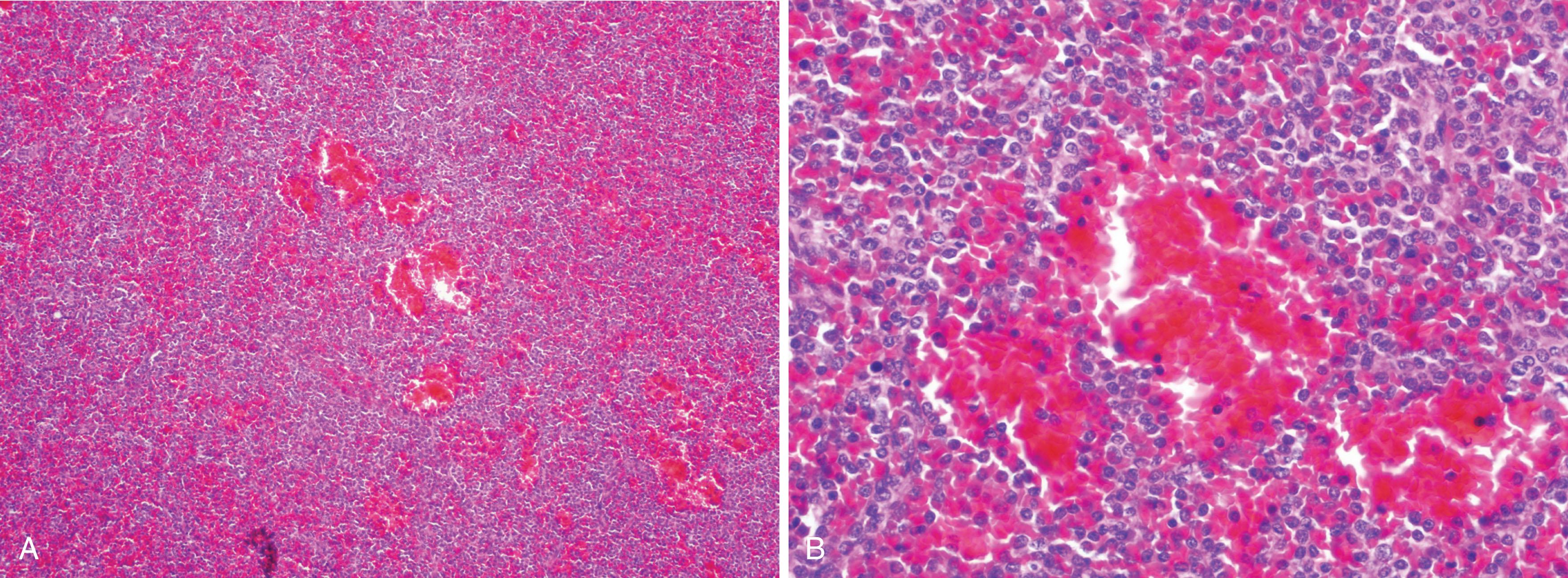 Figure 77.6, PATHOLOGIC FINDINGS IN THE SPLEEN.