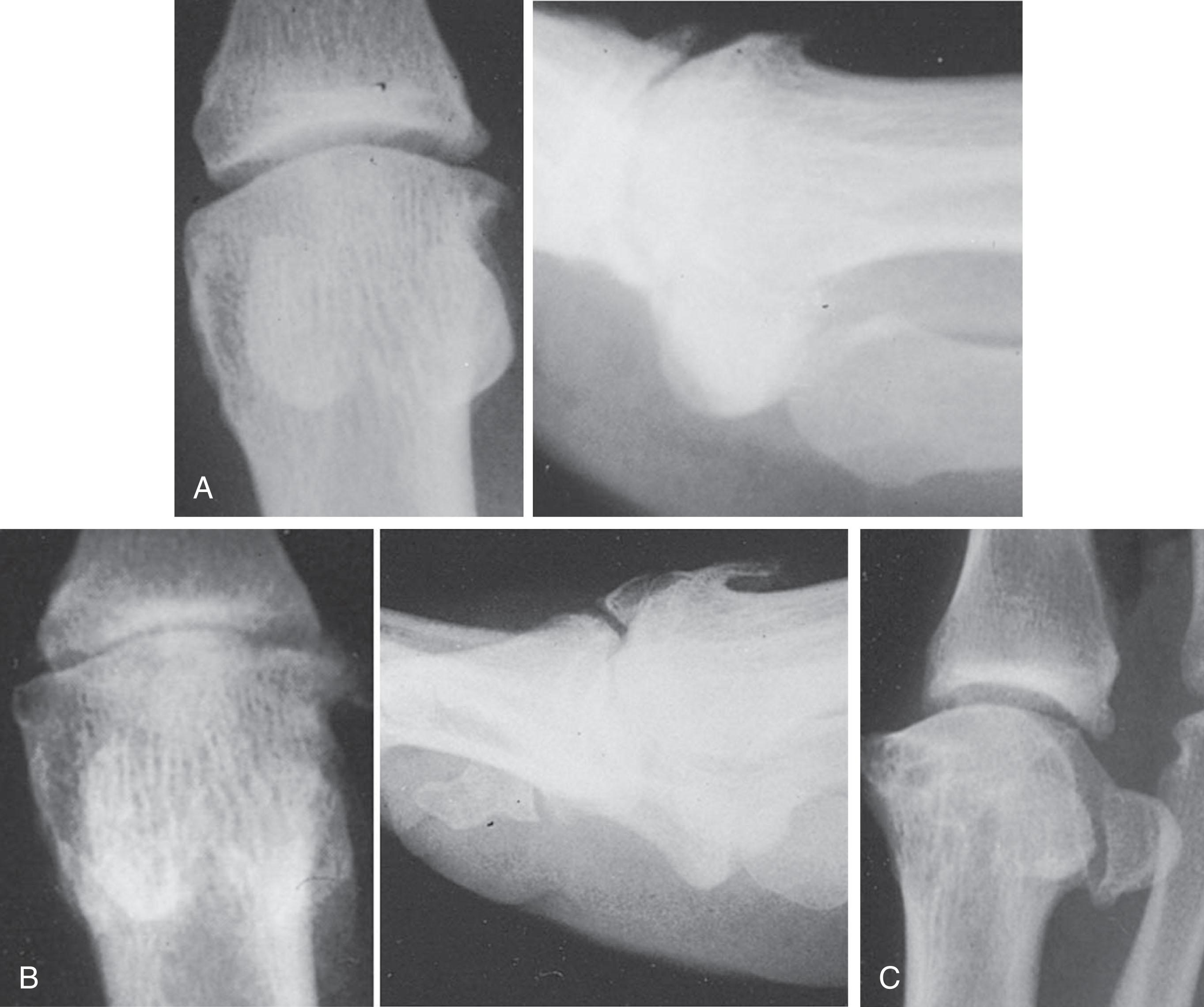 Fig. 27-1, A , Anteroposterior (AP) and lateral radiographs demonstrate grade 1 hallux rigidus deformity. B , Over 10 years, significant progression of disease occurred, resulting in a grade 2 hallux rigidus deformity. C , Oblique radiograph demonstrates adequate joint space present, although the AP radiograph did not show an adequate joint space because of overhanging osteophytes.