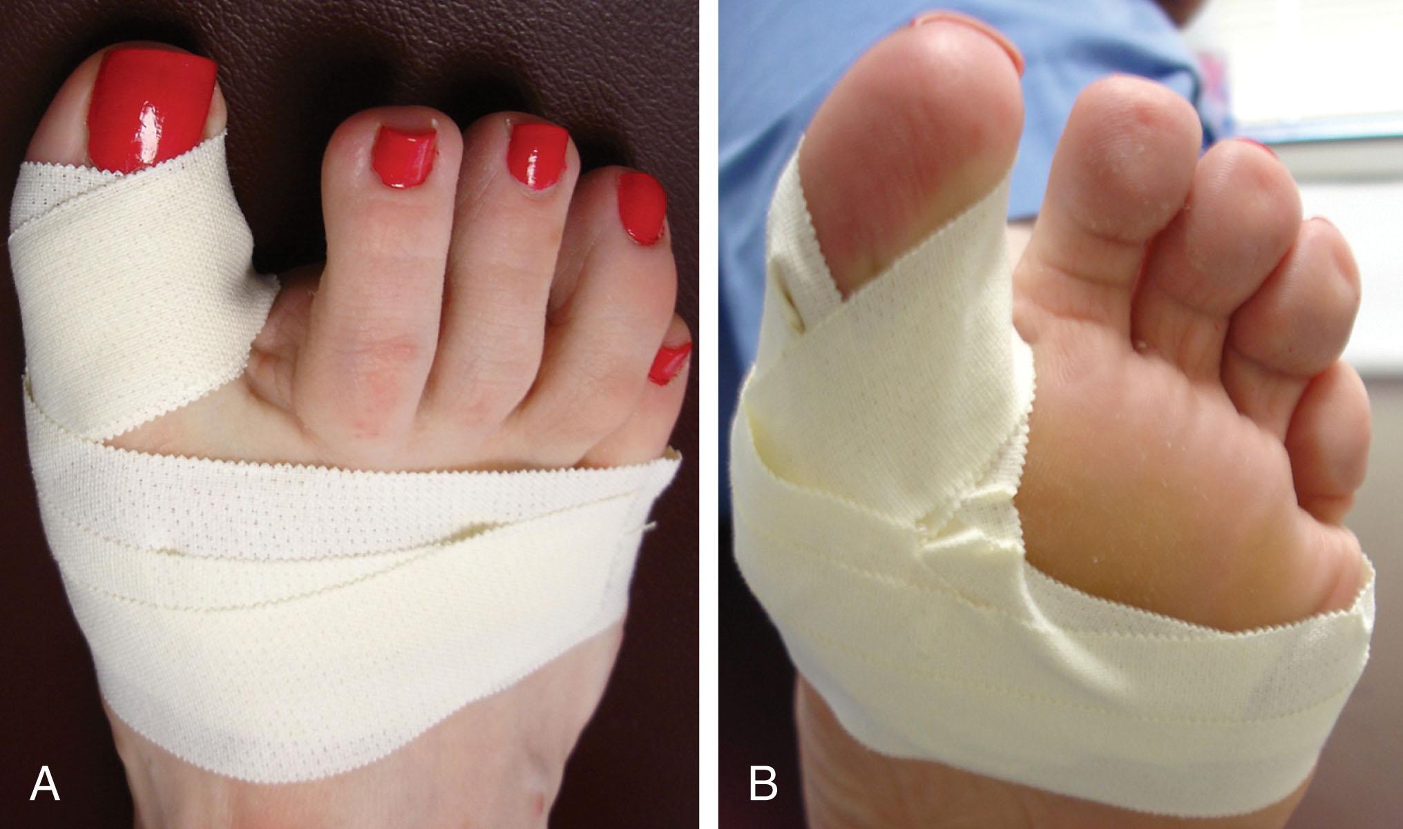 Fig. 27-12, Taping of the hallux to decrease dorsiflexion excursion may reduce pain. A , Dorsal view. B , Plantar view.