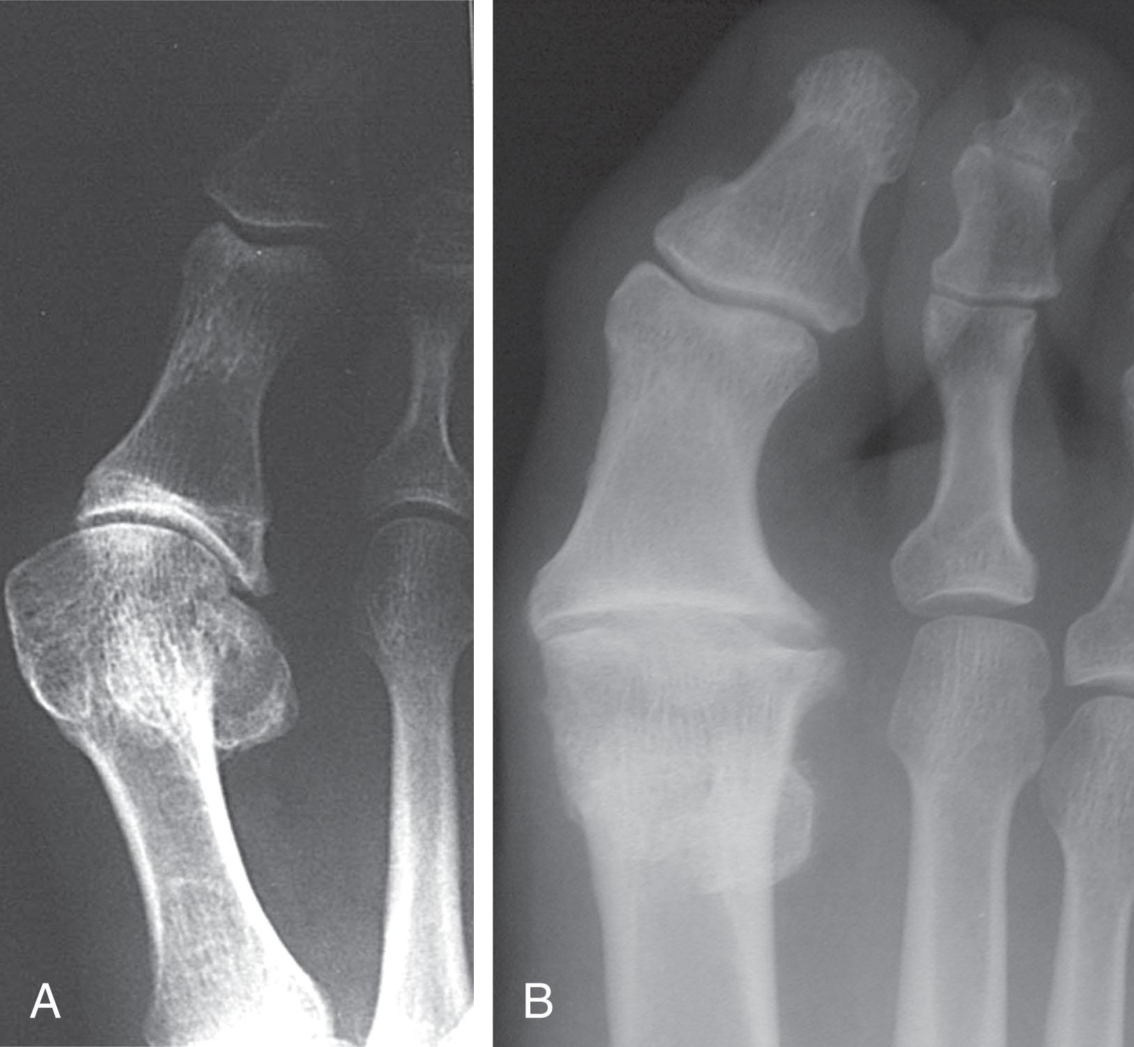 Fig. 27-14, A , Hallux valgus is rarely seen in association with hallux rigidus. B , Hallux valgus interphalangeus is commonly seen. An average hallux valgus interphalangeus angle of 17 degrees is reported.