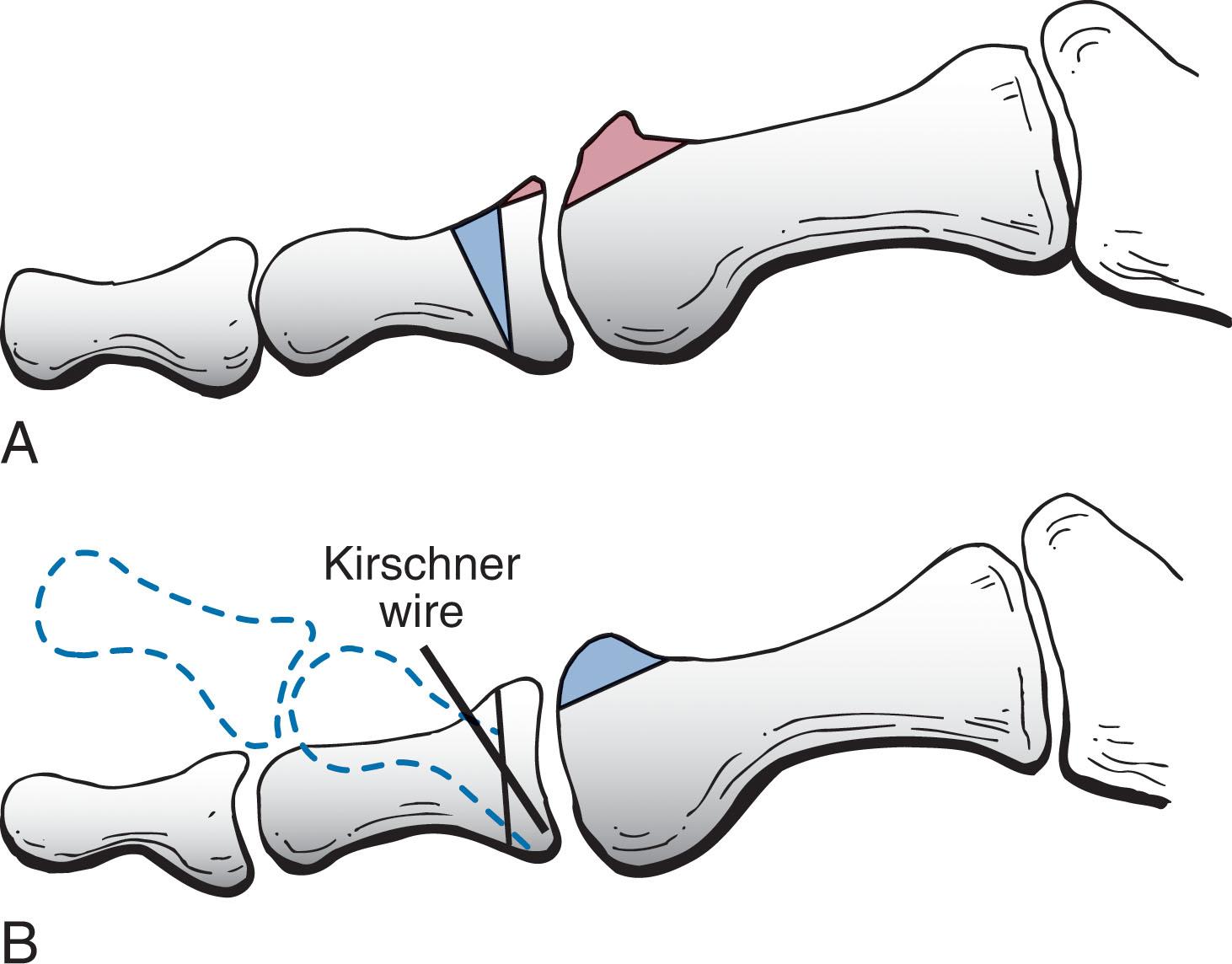 Fig. 27-15, Moberg procedure. Dorsal closing-wedge osteotomy of proximal phalanx is used to correct hallux rigidus. This exchanges plantar flexion for dorsiflexion. A , Proposed osteotomy and cheilectomy. B , After closing-wedge osteotomy.