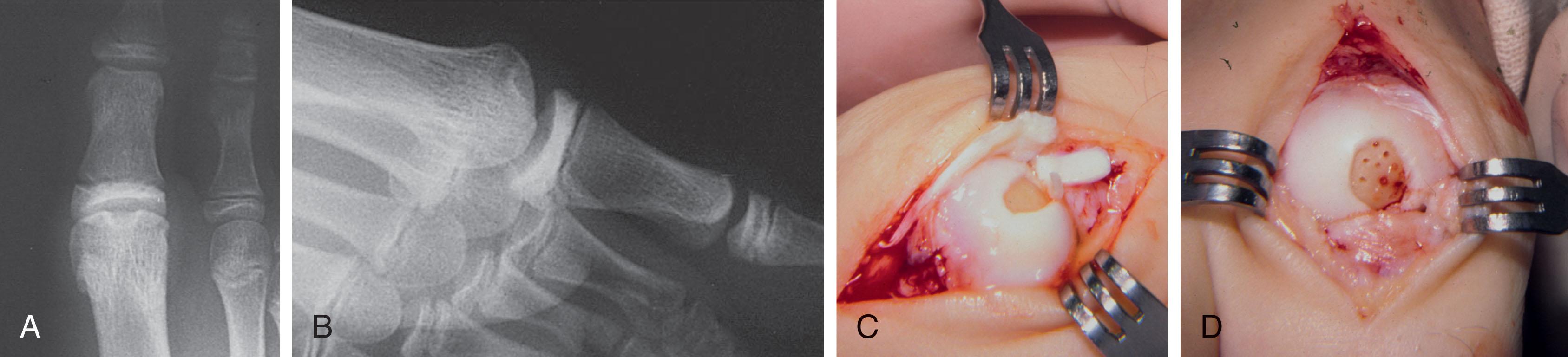 Fig. 27-2, A and B , Radiographs demonstrate juvenile hallux rigidus secondary to osteochondral defect of the metatarsal head. C and D , Intraoperative photographs demonstrate osteochondral lesion. Loose fragment was removed. The lesion was debrided and its base drilled.