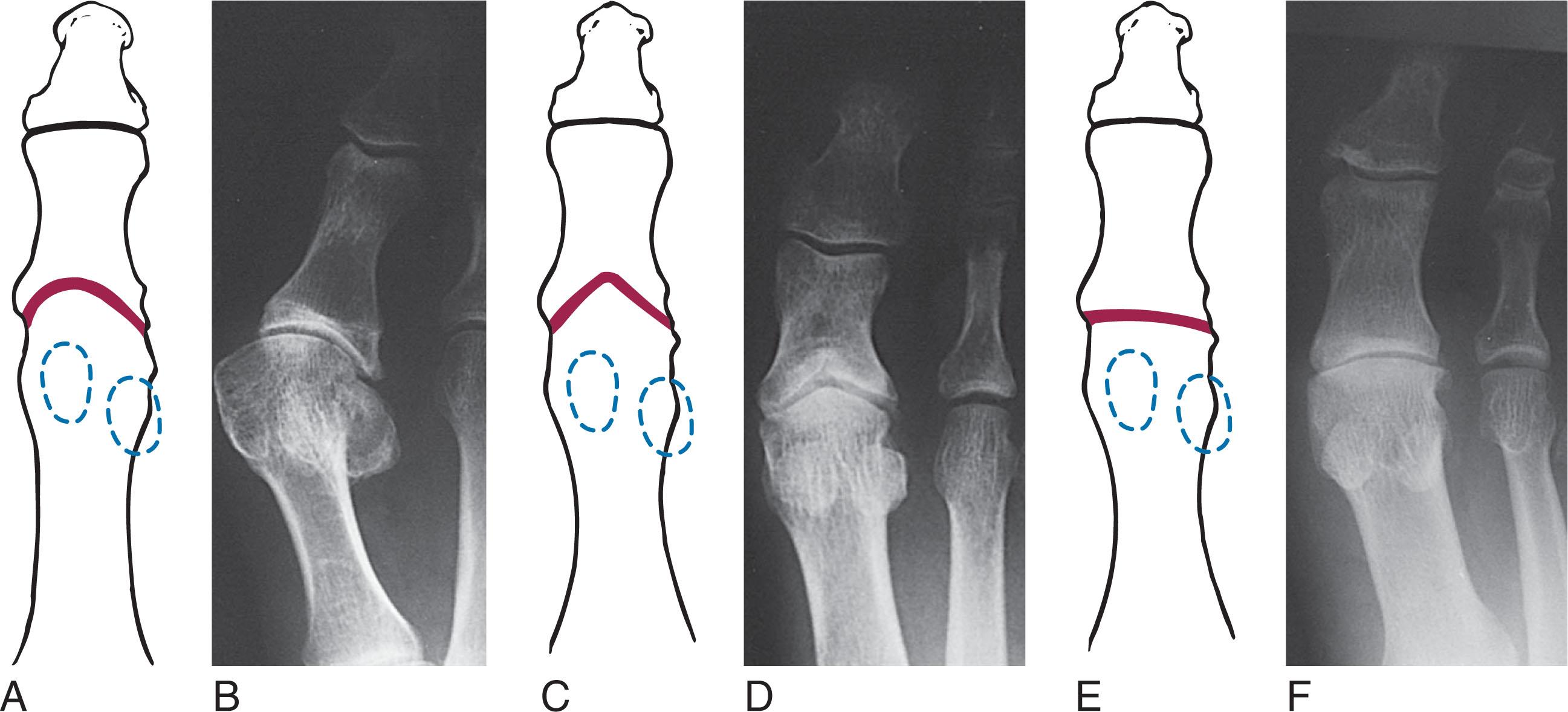 Fig. 27-3, Variations in the shape of the first metatarsal articular surface, with diagrams and radiographs. A and B , Oval shape can allow valgus position to occur. Chevron surface ( C and D ) and flat surface ( E and F ) resist lateral pressure on the hallux. Although hallux valgus is uncommon, traumatic osteoarthritis can develop, resulting in hallux rigidus.