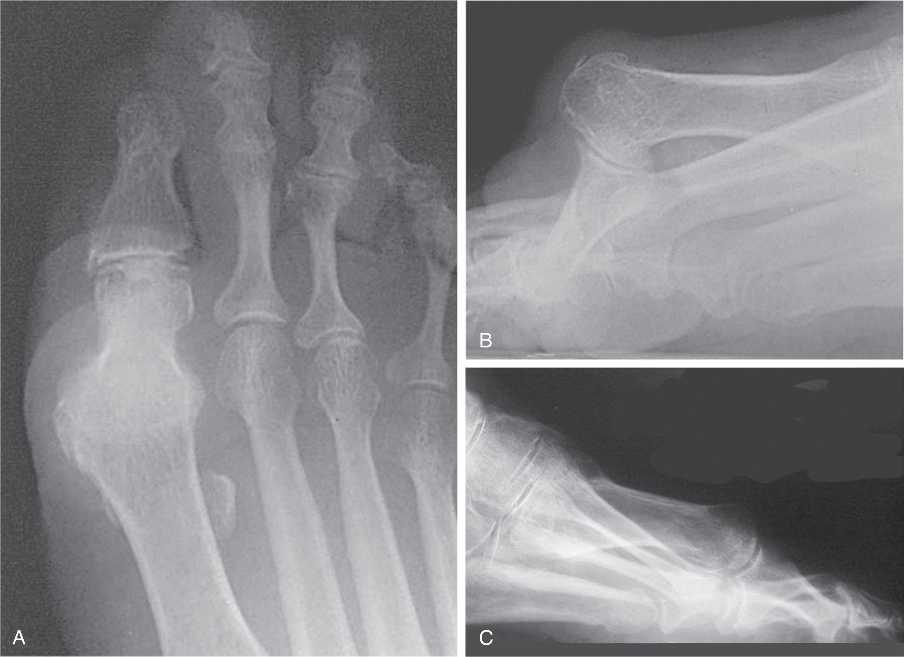 Fig. 27-4, Anteroposterior (A) and lateral (B) radiographs of a severe case of hallux flexus with metatarsus primus elevatus. C , Severe postsurgical elevatus.