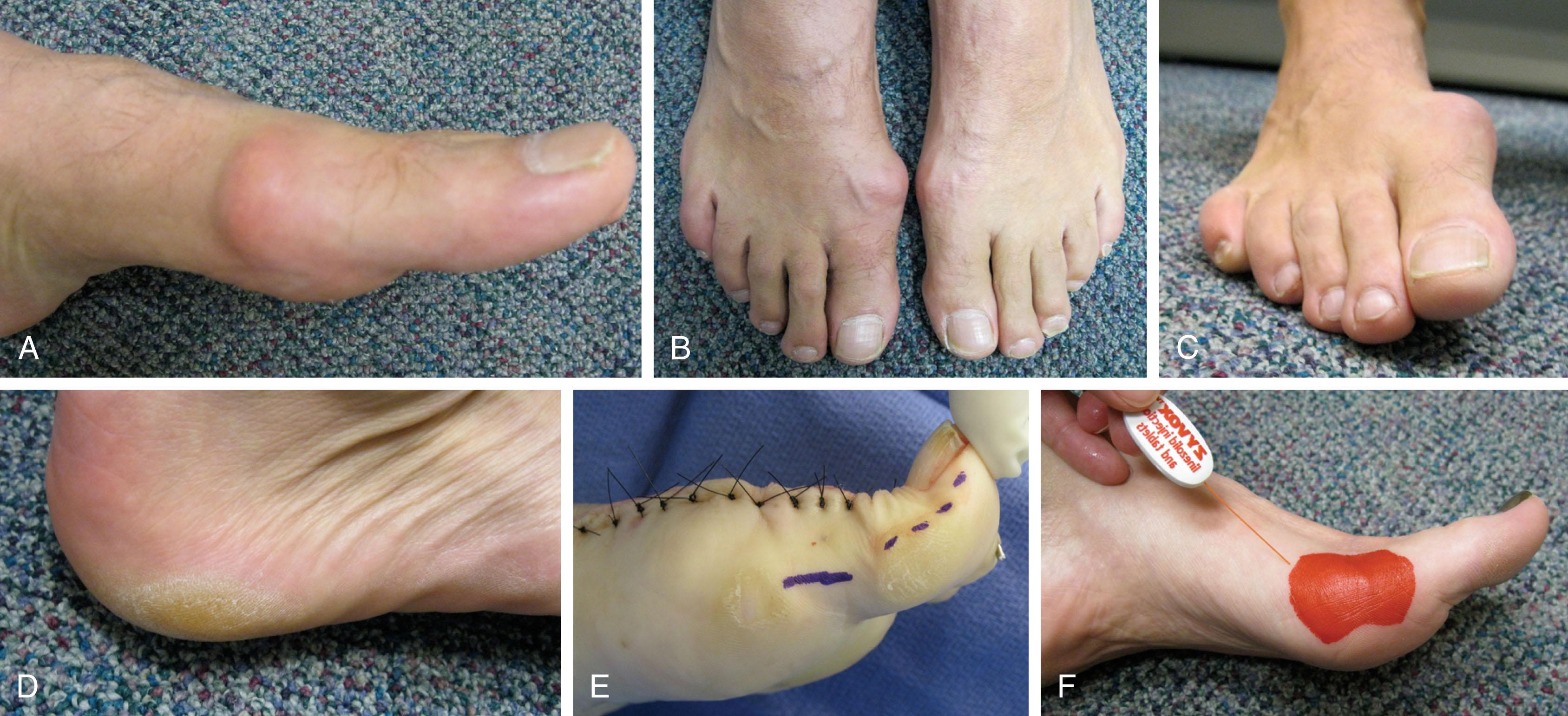 Fig. 27-5, Clinical findings of hallux rigidus. A , Swollen hallux metatarsophalangeal (MTP) joint. B , Note enlarged right great toe MTP joint compared with the left foot. C , Everted gait develops because of stiff first MTP joint. D , Callus develops on lateral heel because of everted gait. E , Hyperextension of hallux interphalangeal joint because of restricted motion at MTP joint. F , Numbness develops over medial sensory nerve to the hallux because of pressure from enlarged osteophytes associated with hallux rigidus.