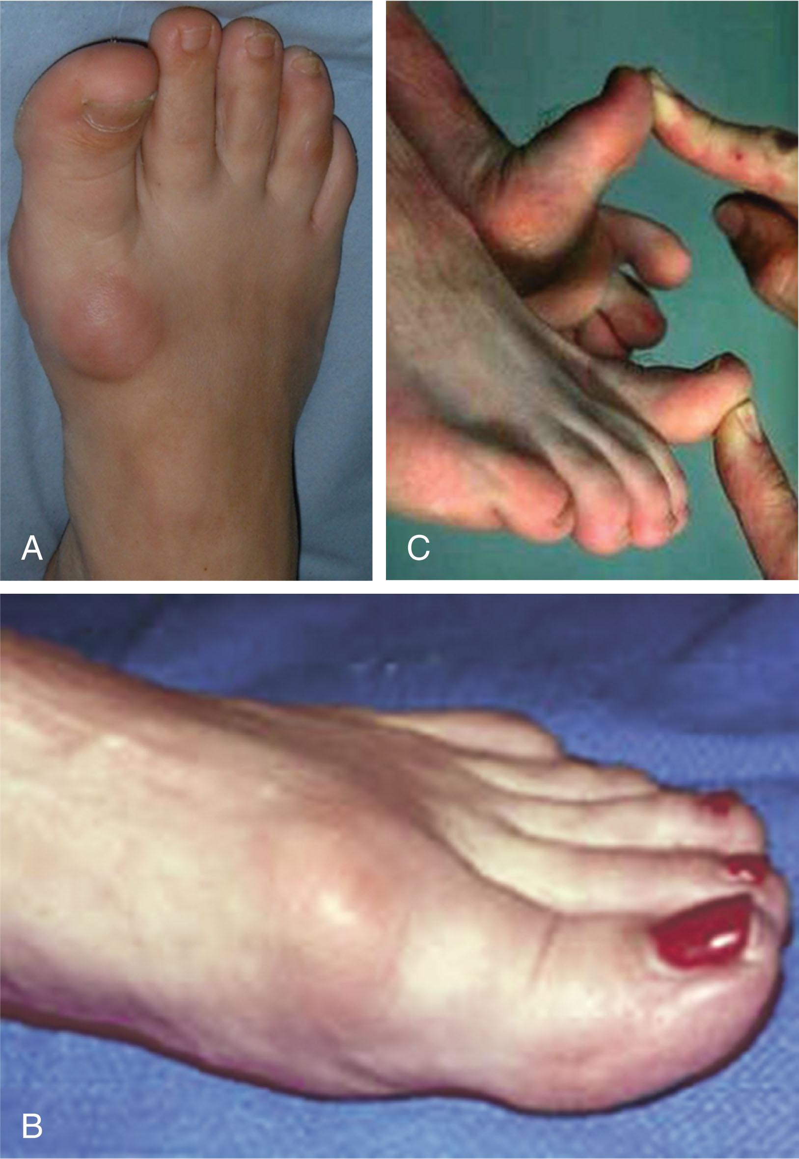 Fig. 27-6, First metatarsophalangeal joint of a patient with hallux rigidus. Note increased bulk dorsally (A) and medially (B) . C , There is restricted dorsiflexion compared with the contralateral side.