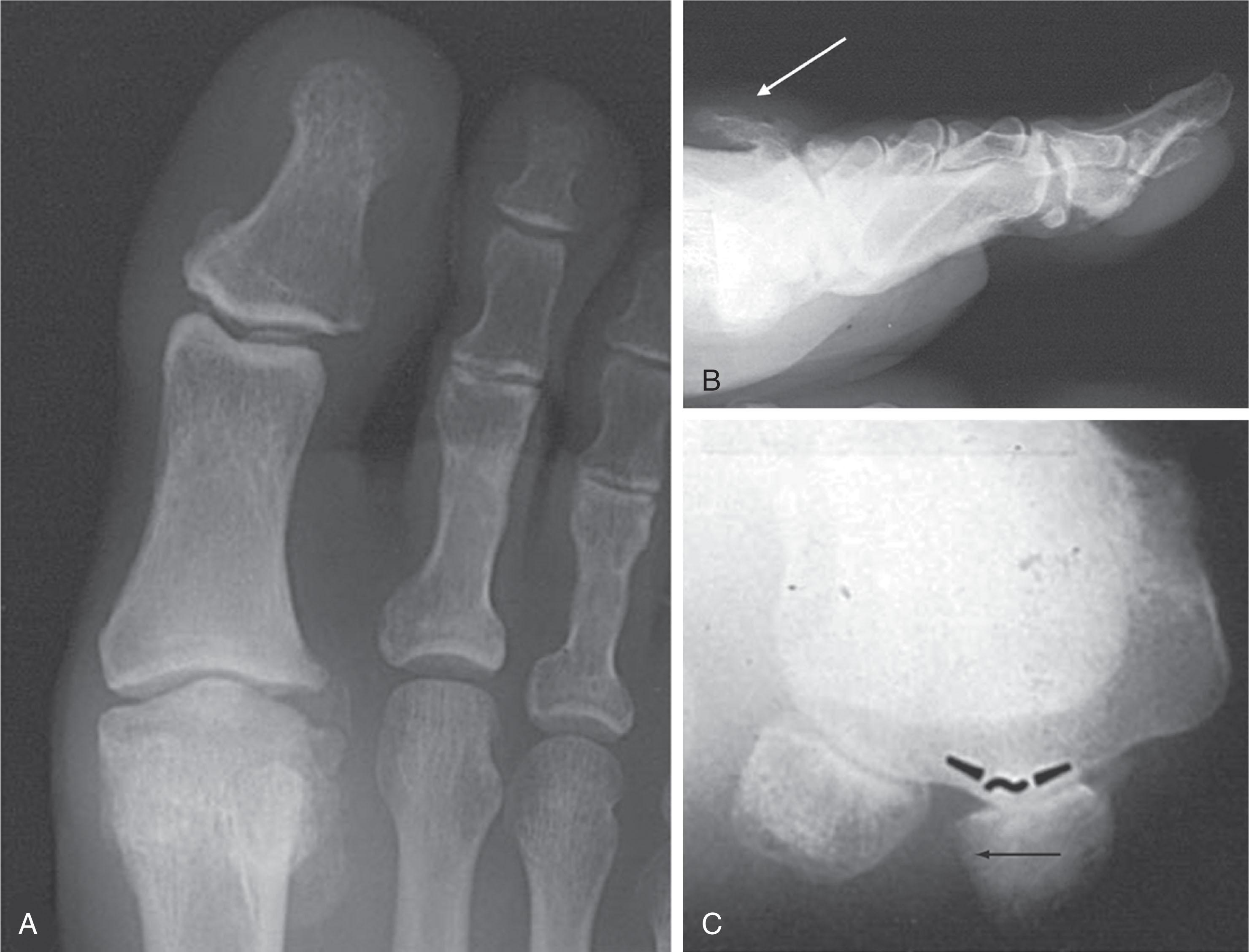 Fig. 27-7, Grade II hallux rigidus. A , Anteroposterior radiograph. B , Lateral radiograph demonstrates a large dorsal osteophyte resembling dripping candle wax ( arrow ). C , Axial view demonstrates unusual occurrence of osteoarthritis of the medial sesamoid ( arrow ) associated with hallux valgus.