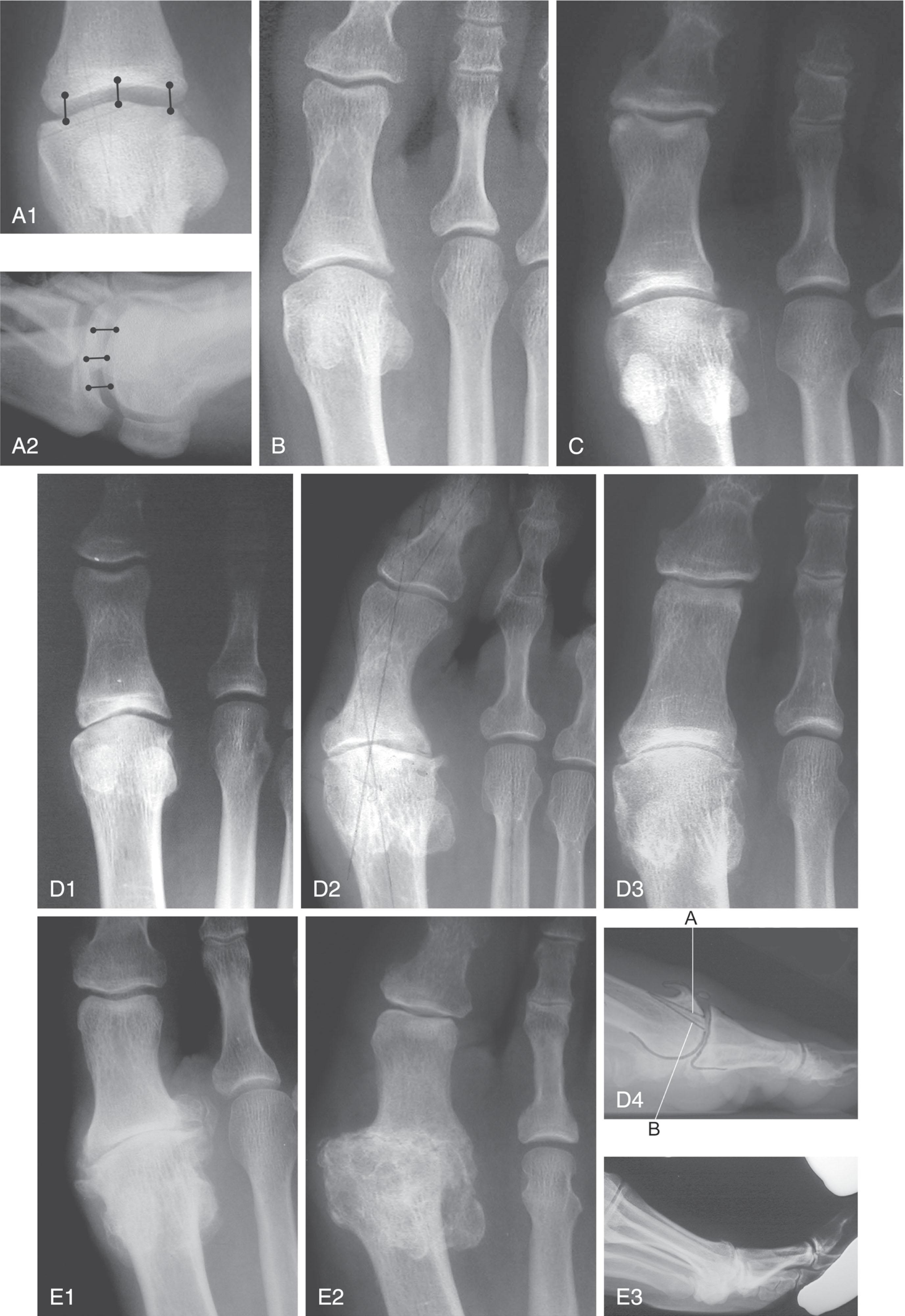 Fig. 27-8, Anteroposterior (AP) (A1) and lateral (A2) radiographs demonstrating the authors’ technique of measuring the width of the metatarsophalangeal (MTP) joint space. Marks are made medially, centrally, and laterally along the joint surface on both the AP and lateral radiographs. The distance between the marks is measured with a ruler corrected for magnification. The measurements are averaged and compared with the contralateral side or a normal articular length if there is bilateral disease. In this example, this is grade 0 hallux rigidus; the radiograph demonstrates essentially a normal joint on both AP and lateral views. B , Grade 1 hallux rigidus. The radiograph shows mild periarticular osteophyte formation, but notable loss of passive motion is detected clinically. C , Grade 2 hallux rigidus with notable increase in periarticular osteophytes. D1 to D3 , Grade 3 hallux rigidus with progressive chondrolysis and osteophyte formation. D4 , Lateral radiograph shows substantial cartilage space remaining in the joint. Line A is a flat cut of the osteophyte and line B demonstrates a more aggressive cheilectomy, which typically results in greater postoperative range of motion. E1 and E2 , Grade 4 hallux rigidus with pain in the midrange of motion and substantial or complete chondrolysis of the MTP joint. E3 , Grade 3 is distinguished clinically from grade 4 by the absence of pain at the midrange of motion, but the two can be identical radiographically.