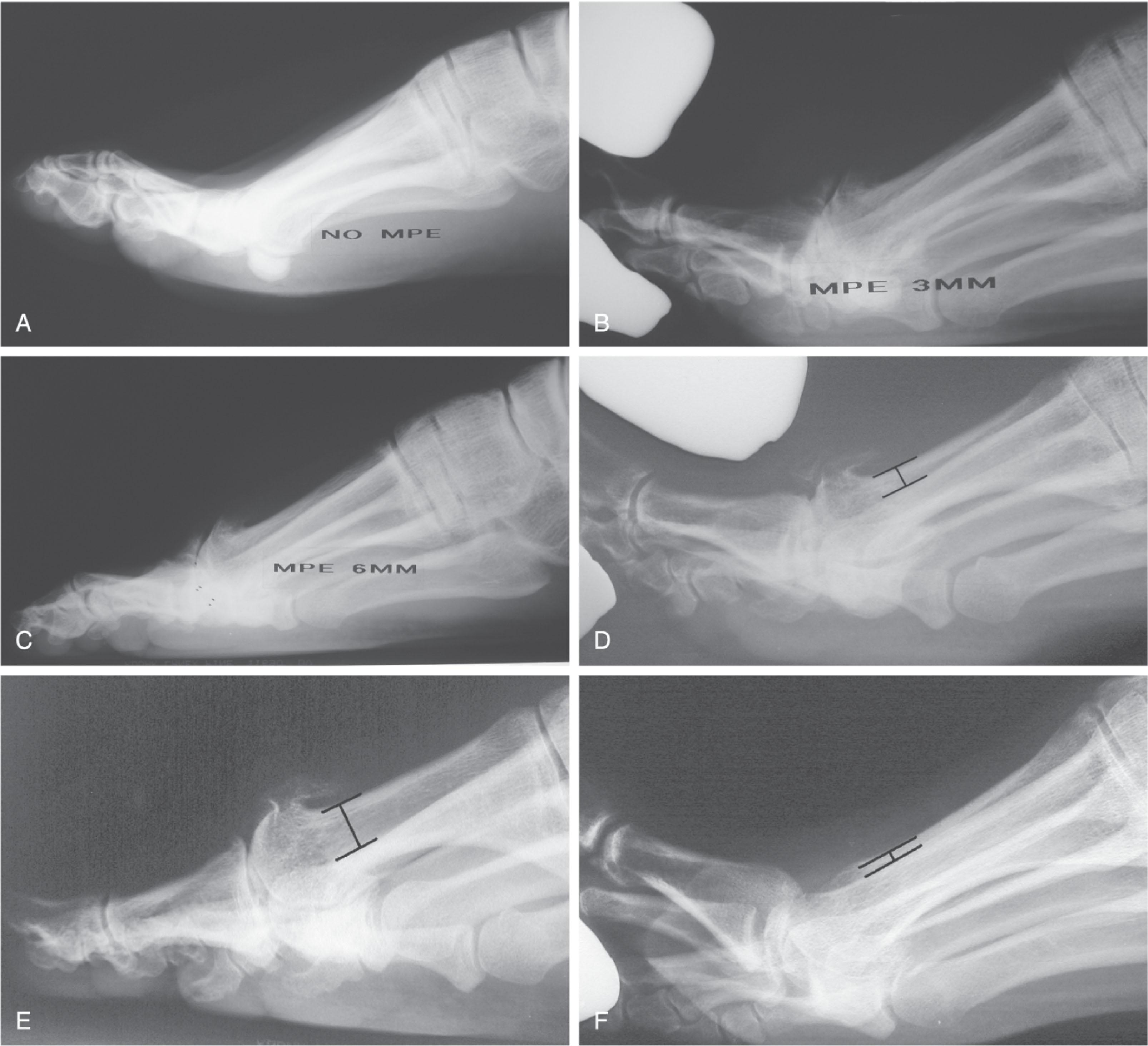 Fig. 27-9, The effect of dorsiflexion stress on the first metatarsophalangeal (MTP) joint with hallux rigidus. Metatarsus primus elevatus correlates with MTP joint arthrosis noted in sequential radiographs taken over an 11-year period. A , Early grade 1 hallux rigidus with no metatarsus elevatus. B , Six years later, elevatus is 3 mm with or without stress test. C , Eleven years later, elevatus is 6 mm. D , Dorsiflexion stress reduces elevatus to 3 mm. E , Elevatus does increase with increasing grade of hallux rigidus. F , Elevatus is often reduced after either a cheilectomy or MTP arthrodesis.