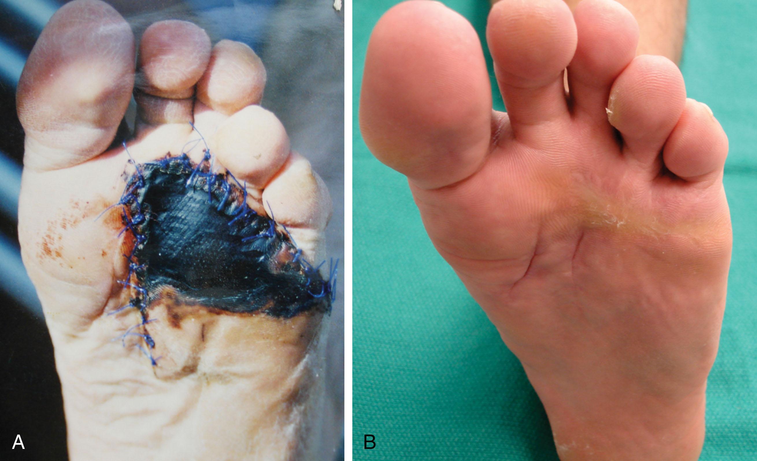 Fig. 8-3, Skin slough. A , Full-thickness skin slough on the plantar aspect of foot covered by skin graft, which unfortunately necrosed. B , With time and local wound care, the area of skin loss contracted and healed.
