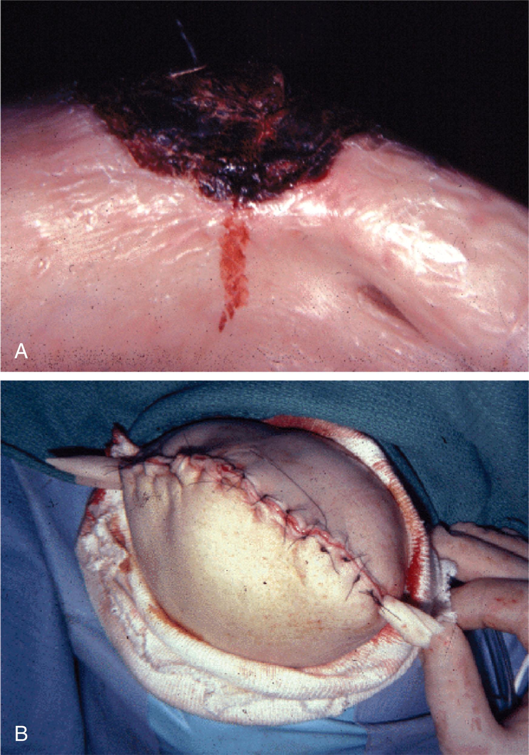 Fig. 8-4, A , Skin slough after bunion surgery in a patient with vascular insufficiency. B , Above-knee amputation was eventually required.