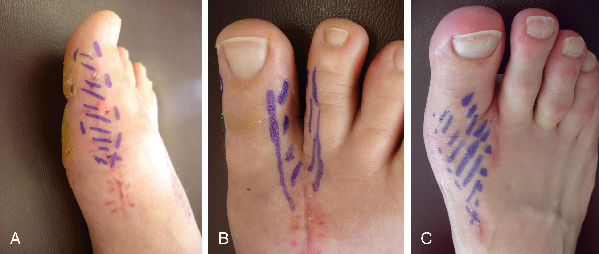 Fig. 8-5, Iatrogenic injuries to nerves at surgery can lead to numbness and paresthesias. A , Dorsal medial cutaneous nerve to the hallux. B , Common digital nerve to the first web space. C , Injury to the superficial peroneal nerve.