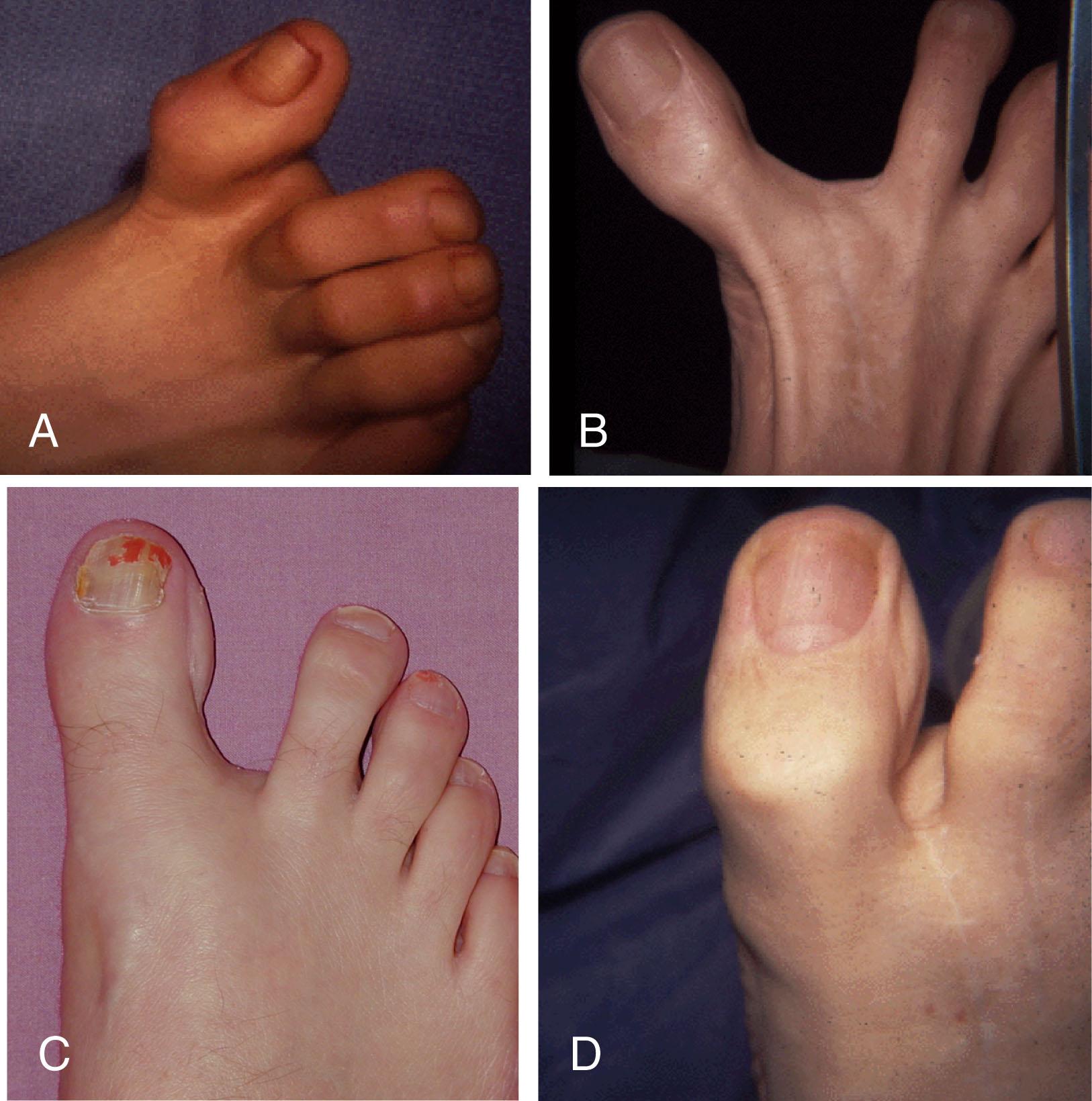 Fig. 8-9, Hallux varus deformity. A , “Classic” hallux varus deformity with medial deviation and a cock-up deformity of the first metatarsophalangeal (MTP) joint after a distal soft tissue procedure. B , Hallux varus deformity with medial deviation of the MTP joint but no cock-up deformity of the joint. This type of varus may occur with both sesamoids intact. C , Mild hallux varus deformity. D , Mild varus associated with a mild cock-up deformity of the first MTP joint and flexion of the interphalangeal joint.