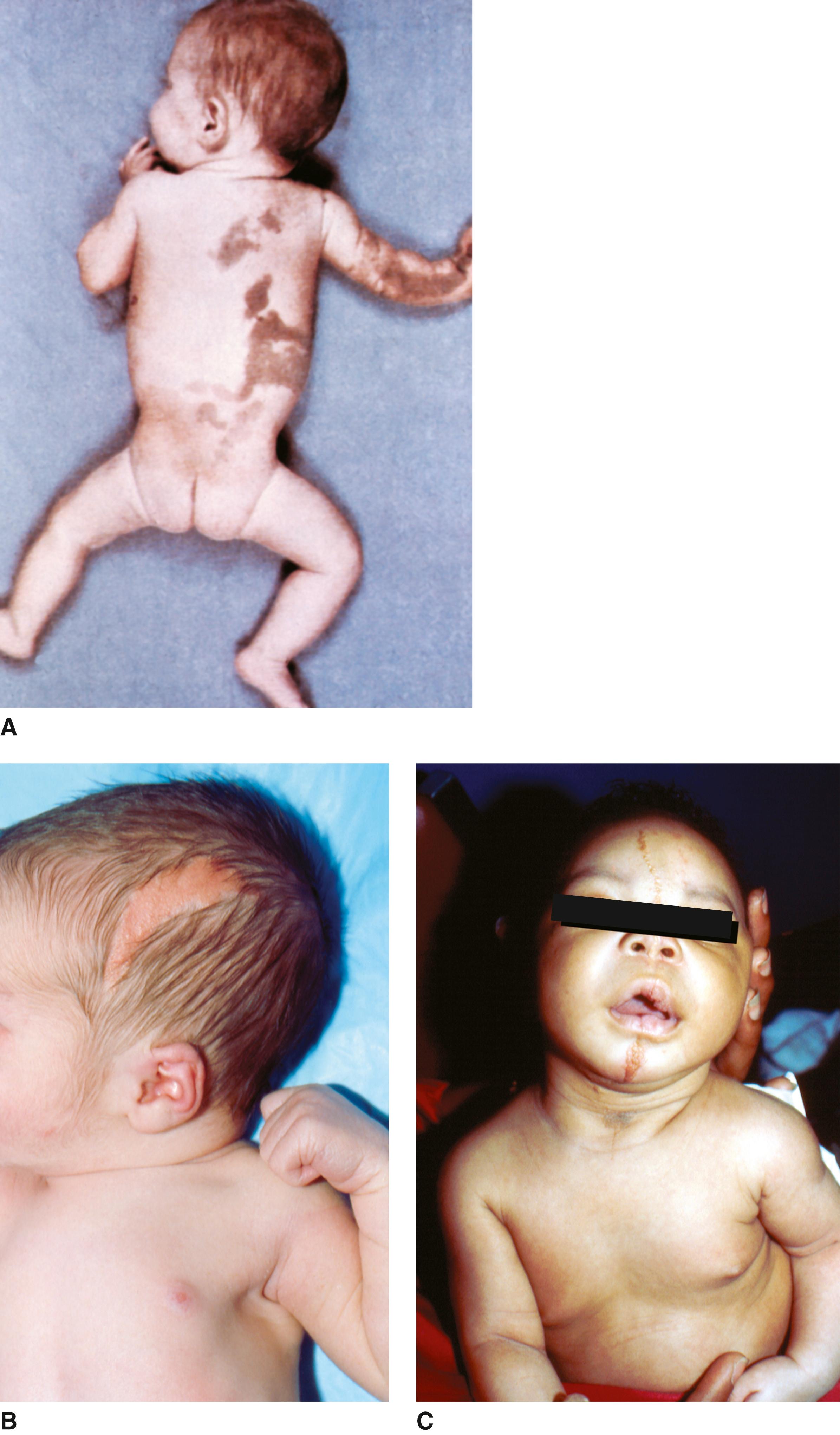 FIGURE 1, Linear sebaceous nevus sequence.