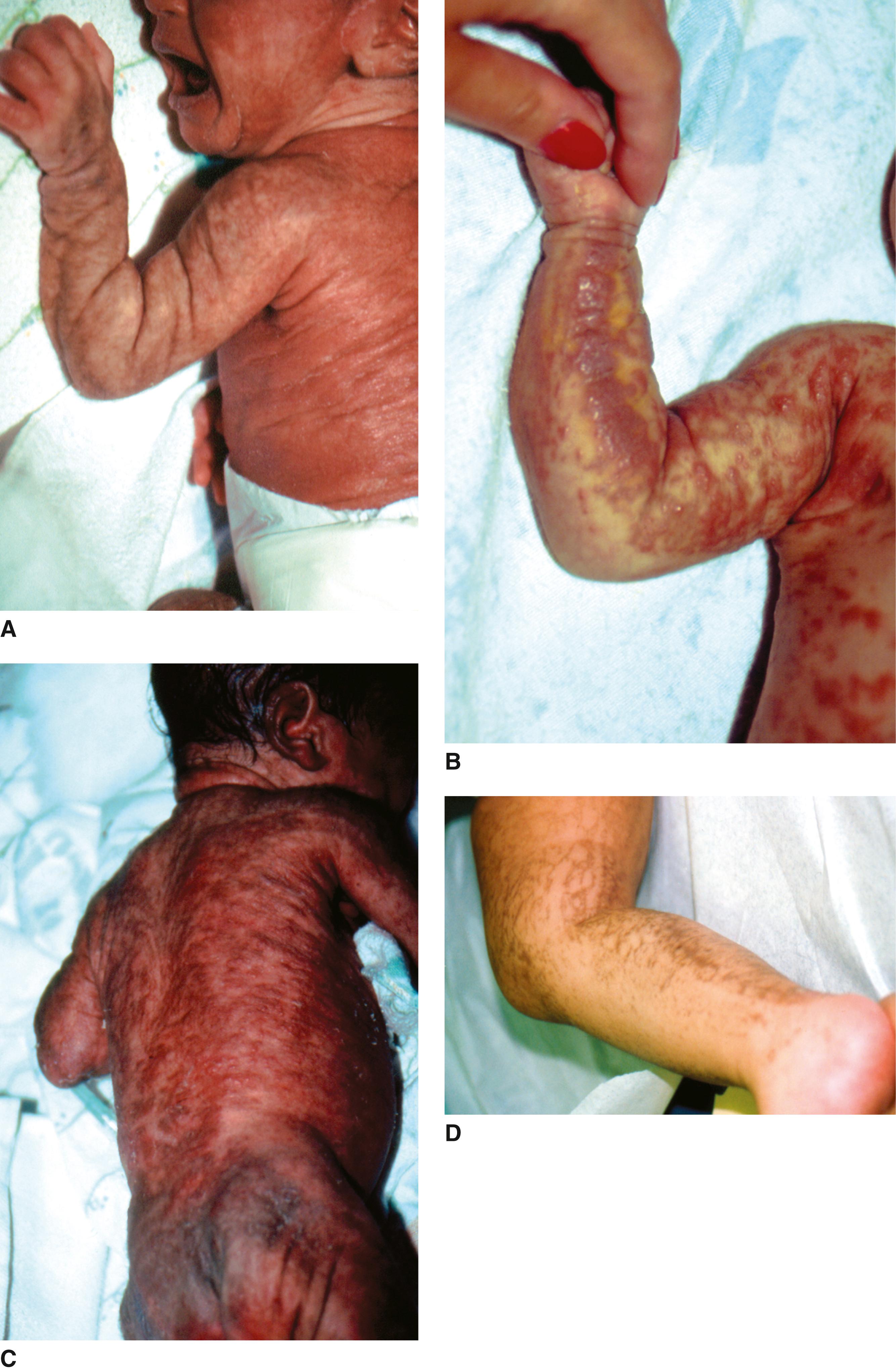 FIGURE 1, Incontinentia pigmenti syndrome.