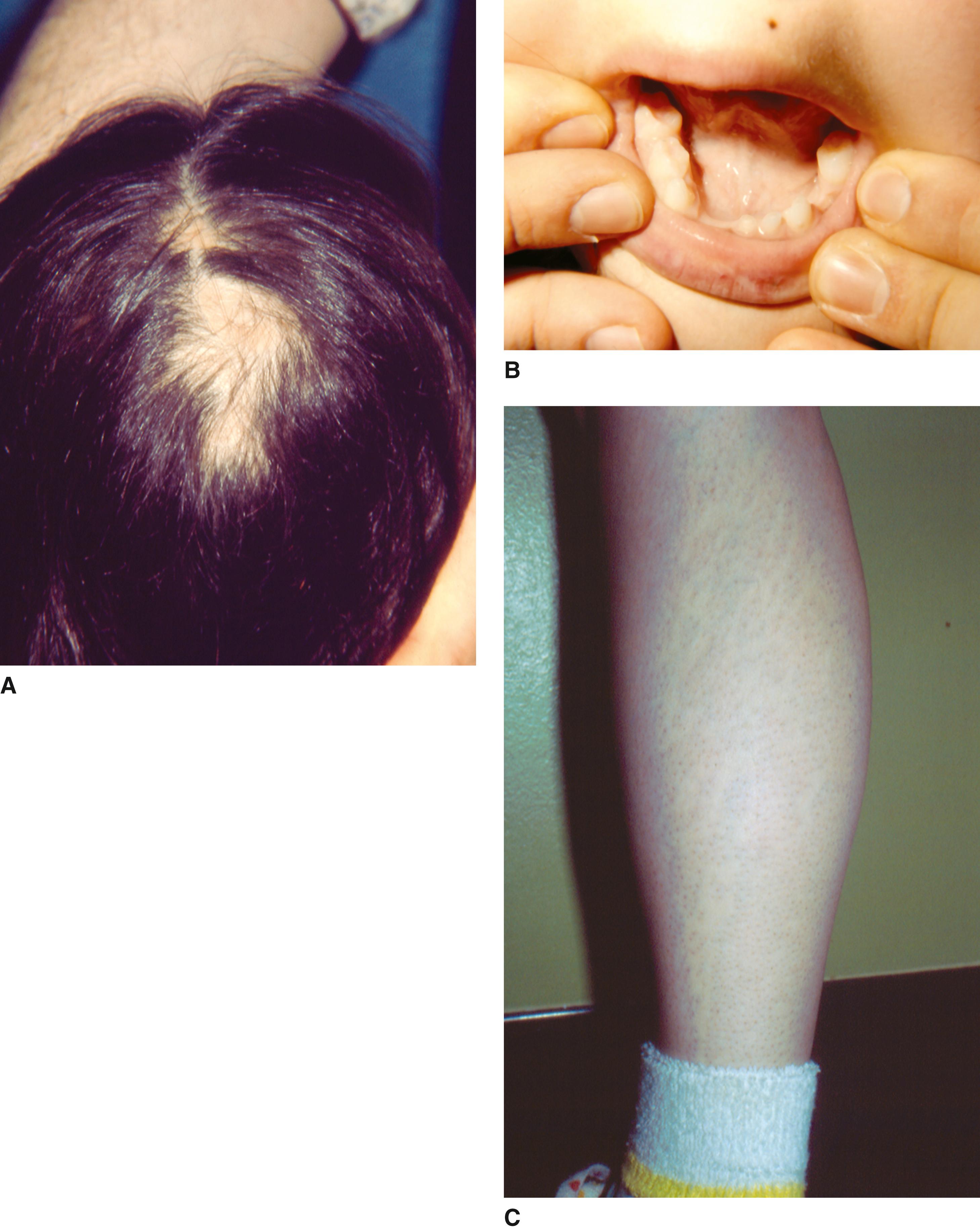 FIGURE 2, A, Atrophic patchy alopecia. B, Lack of alveolar ridge indicating anodontia. C, Pale hairless streaks on lower leg.