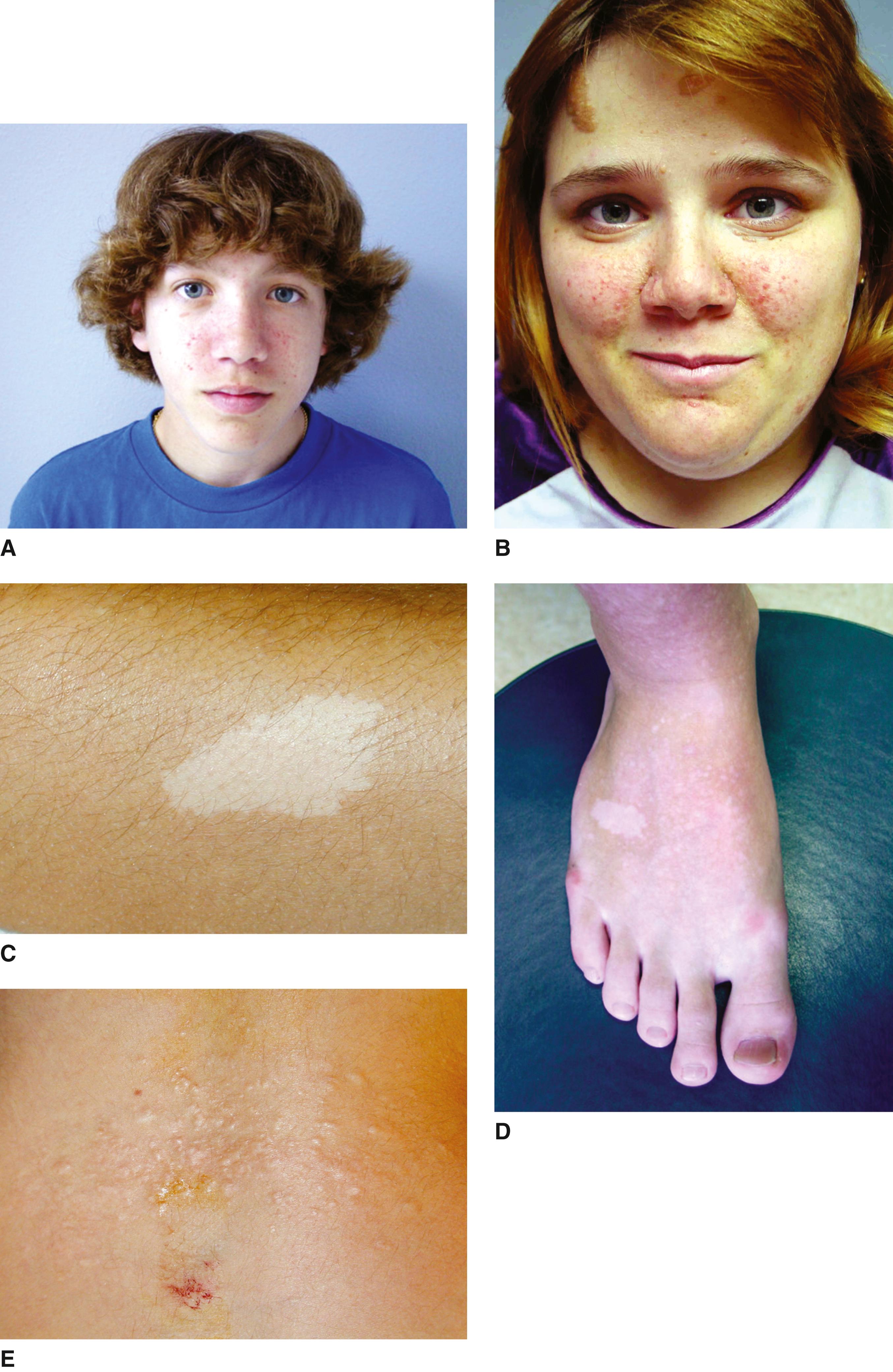 FIGURE 1, Tuberous sclerosis syndrome.