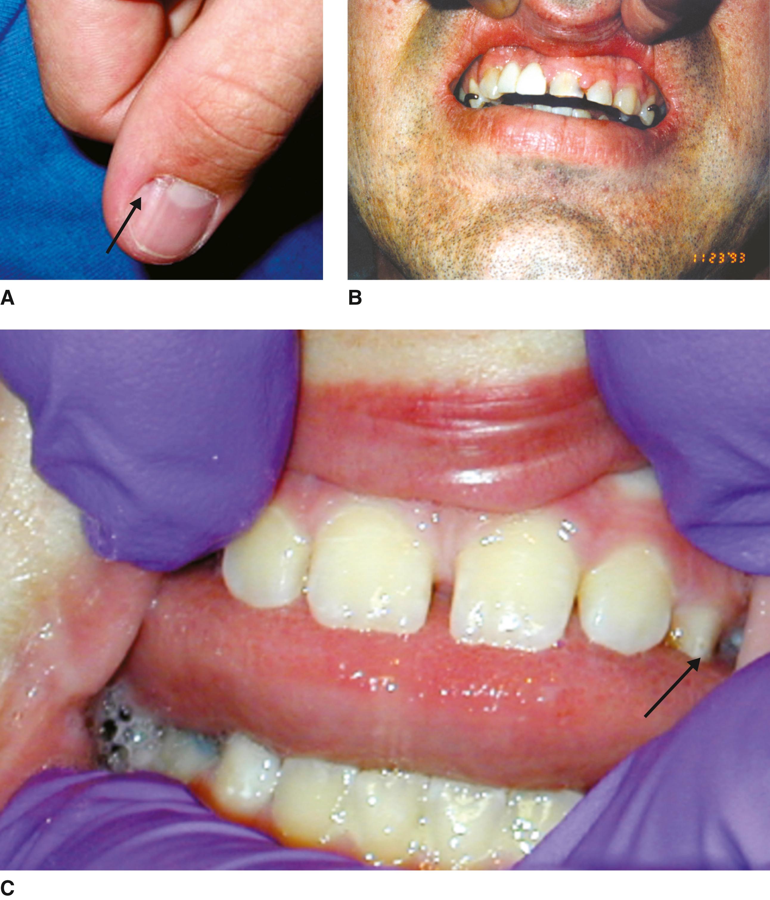 FIGURE 2, A and B, Gingival and subungual fibromata ( arrow in A points to subungual fibroma). C, Pit-shaped enamel defects.