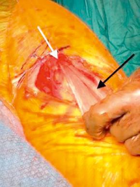 Fig. 86.12, The white arrow points to the ischial tuberosity, where the Achilles allograft (black arrow) has been fixed with an interference screw and suture anchor fixation.