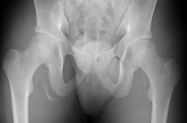 Fig. 86.2, An anteroposterior radiograph of the pelvis showing a bony avulsion of the right ischial tuberosity.