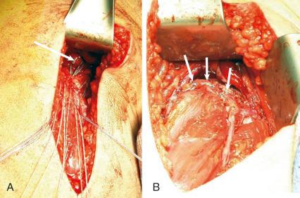 Fig. 86.6, Open repair of the proximal hamstring on the ischial tuberosity (arrow) . (A) The view is of a longitudinal incision in the left hip. Multiple sutures are in place, with the ischial tuberosity visualized in the wound. (B) Final repair of the hamstring, with multiple suture points visualized (arrows) .