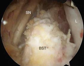 Fig. 86.8, Normal arthroscopic anatomy exposure in a left hip as viewed from the lateral portal. Note the tool entering from the medial portal. BST, common biceps/semitendinosus; L, lateral ischium; SN, sciatic nerve.