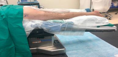 Fig. 86.9, The patient is positioned in the prone position with the break in the operative table flexed to 30 degrees to expose the gluteal fold.