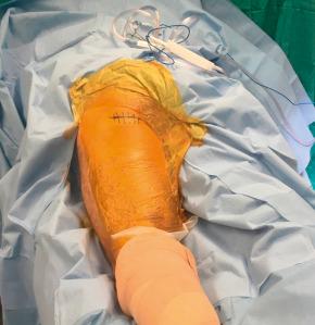 Fig. 86.10, The standard transverse incision is kept as small as possible to perform the surgery safely and adequately, as well as being placed directly in line with the subgluteal skin crease to maximize cosmesis.