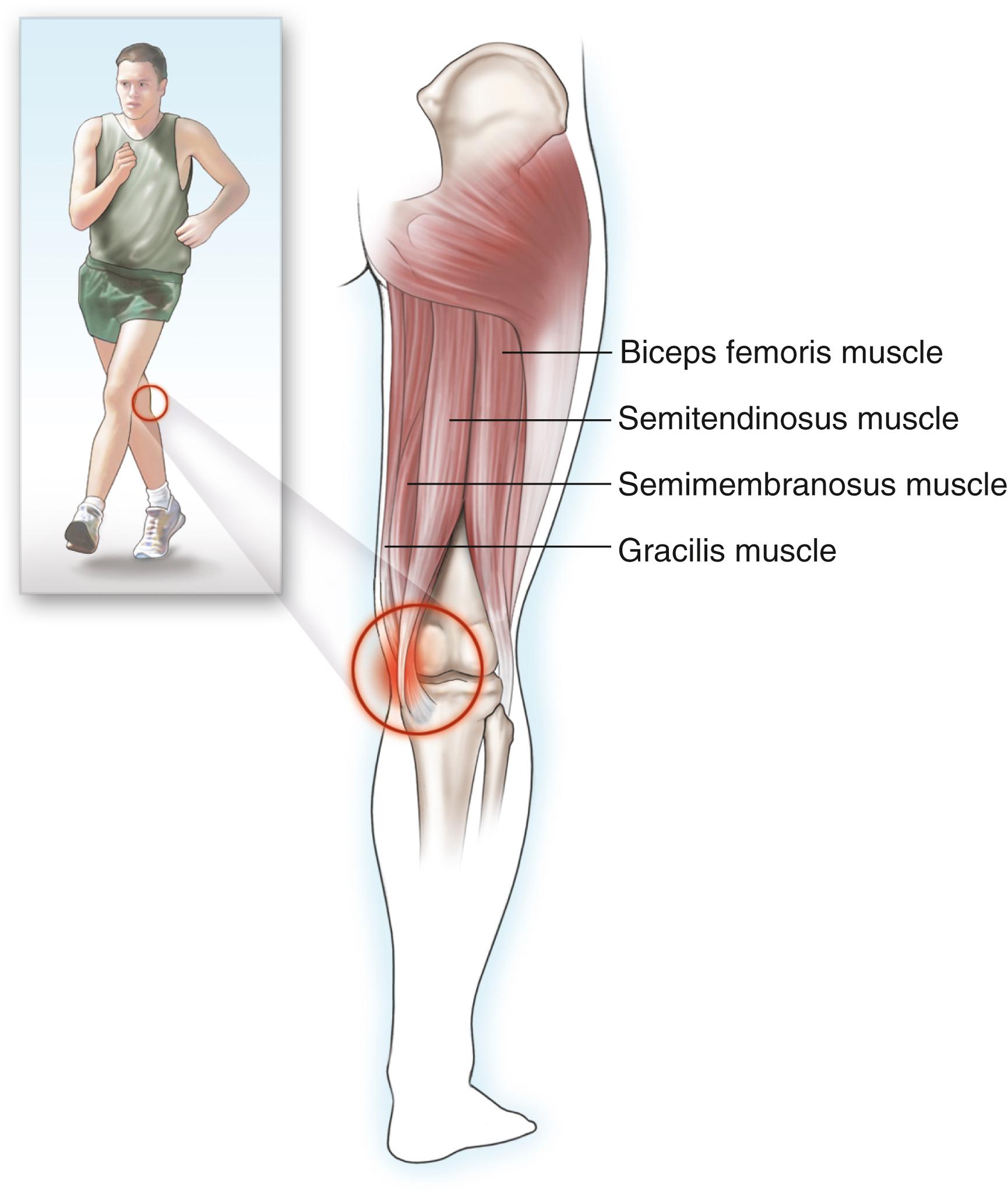 FIG. 165.1, Patients with hamstring tendinitis experience severe pain on palpation over the tendinous insertion, with the medial portion of the tendon more commonly affected than the lateral portion.