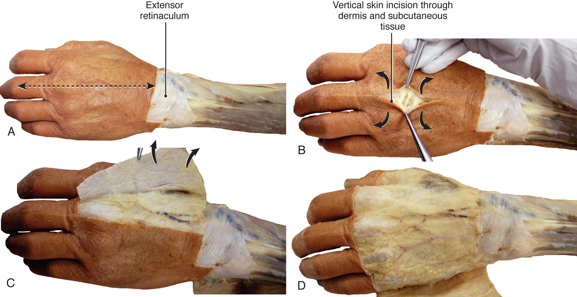 Fig. 9.3, Make a midline incision on the dorsal surface of the hand as indicated in Chapter 8 ( Fig. 8.12 , Fig. 8.13 , Fig. 8.14 , Fig. 8.15 , Fig. 8.16 ).