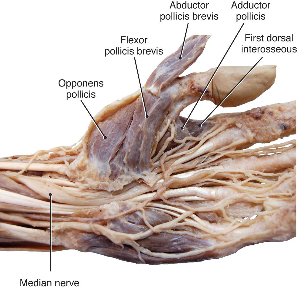 Fig. 9.33, Anterior hand with skin and aponeurosis removed and flexor reticulum cut revealing thenar structures. With abductor pollicis brevis reflected, the deeper-lying opponens pollicis is visualized.