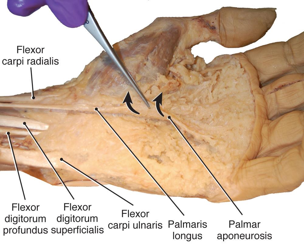 Fig. 9.7, Anterior hand with skin reflected and traction on the palmar aponeurosis. The aponeurosis will be reflected to reveal deeper structures.