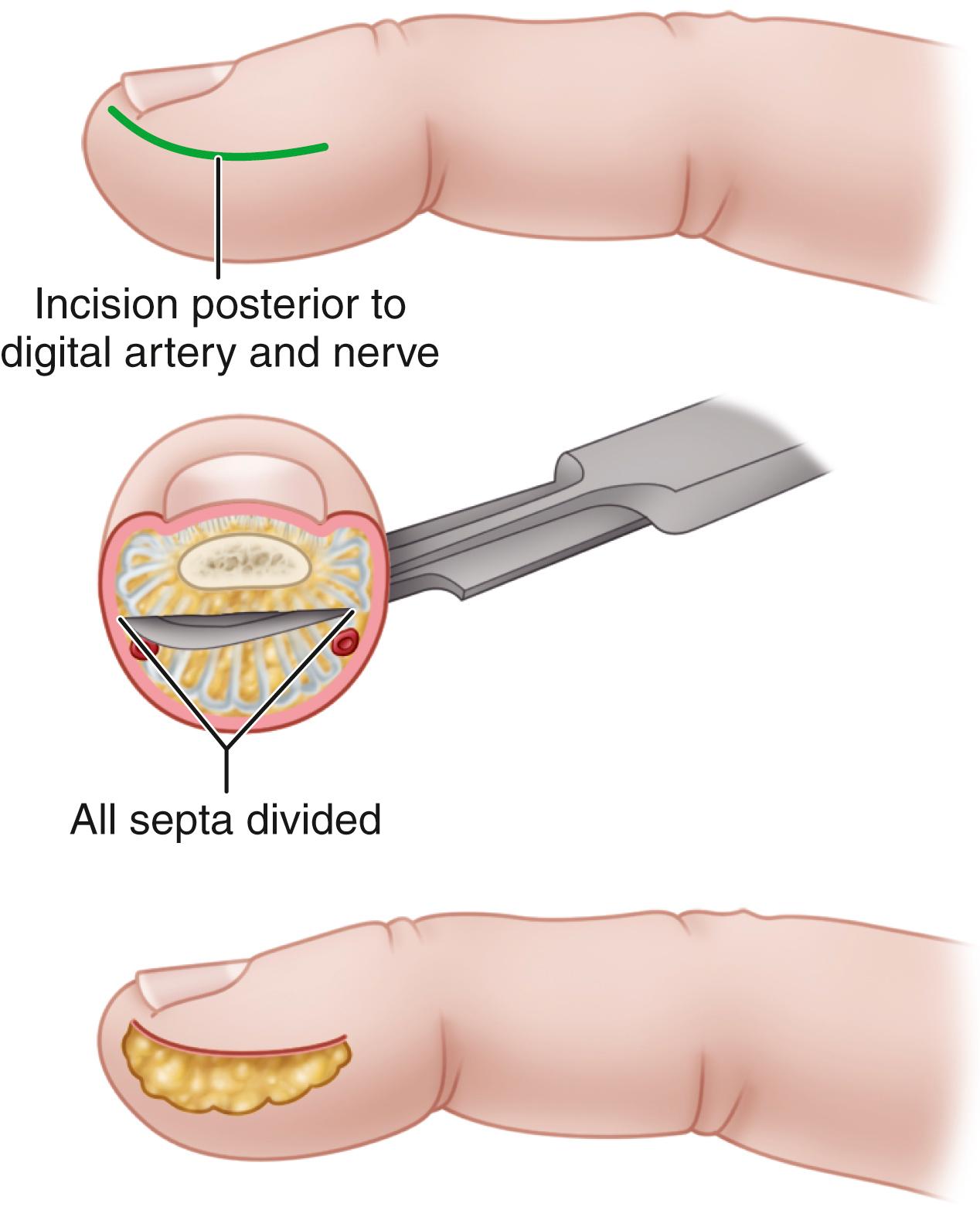 FIGURE 79.6, Incision and drainage of felon. SEE TECHNIQUE 79.3.