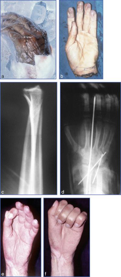 Fig. 16.1, Hand Amputation, Radiocarpal Disarticulation.