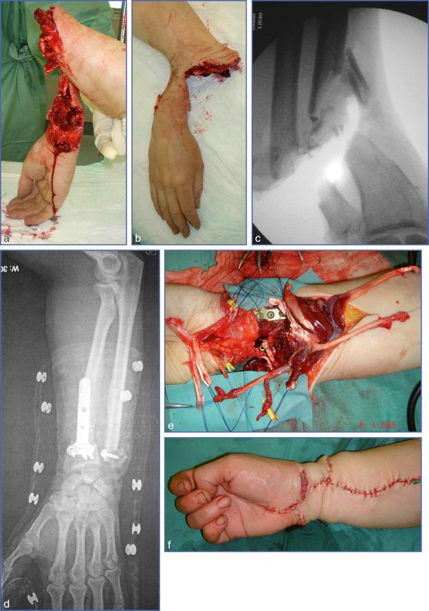 Fig. 16.2, (a, b) Amputation by circular saw in the lower third of the right forearm in a woman. The division of the tendons and neurovascular pedicles is relatively clean. (c, d) The fracture of the radius is comminuted and requires a further resection of 3 cm, which facilitates the débridement of the tendons, vessels and nerves. (e) The tendon and neurovascular structures are identified, and the superficialis tendons are repaired to be used later to restore the function of the intrinsic muscles. (f) At the end of surgery, the right balance between the repair of the extensors and the flexors should place the fingers in semiflexion. (g) A static orthosis is placed on the fifth postoperative day in a position of protection of the wrist and fingers to limit joint stiffness. (h, i) Functional outcome after 1 year. There is 2-point discrimination of 12 mm in the territory of the median nerve; a palmaris longus transfer according to Camitz aids in providing a functional pinch.