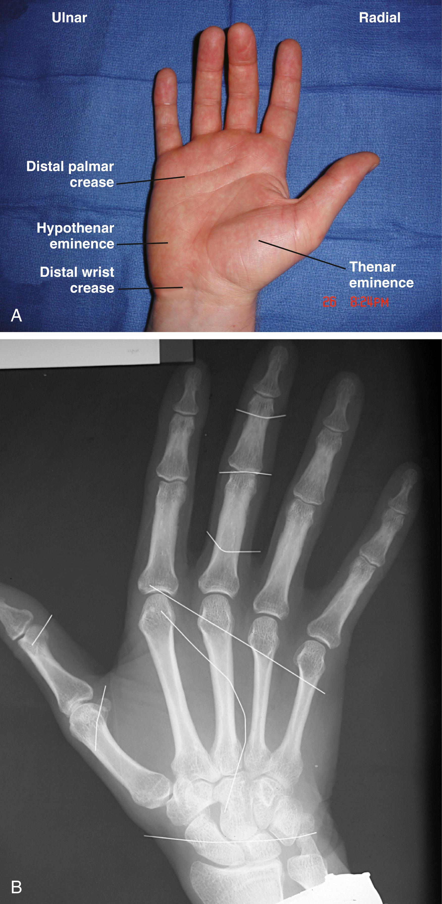 Fig. 70.1, Surface anatomy of the hand. (A) Hand surfaces and nomenclature. (B) Skin creases of the hand superimposed on the skeletal structures.