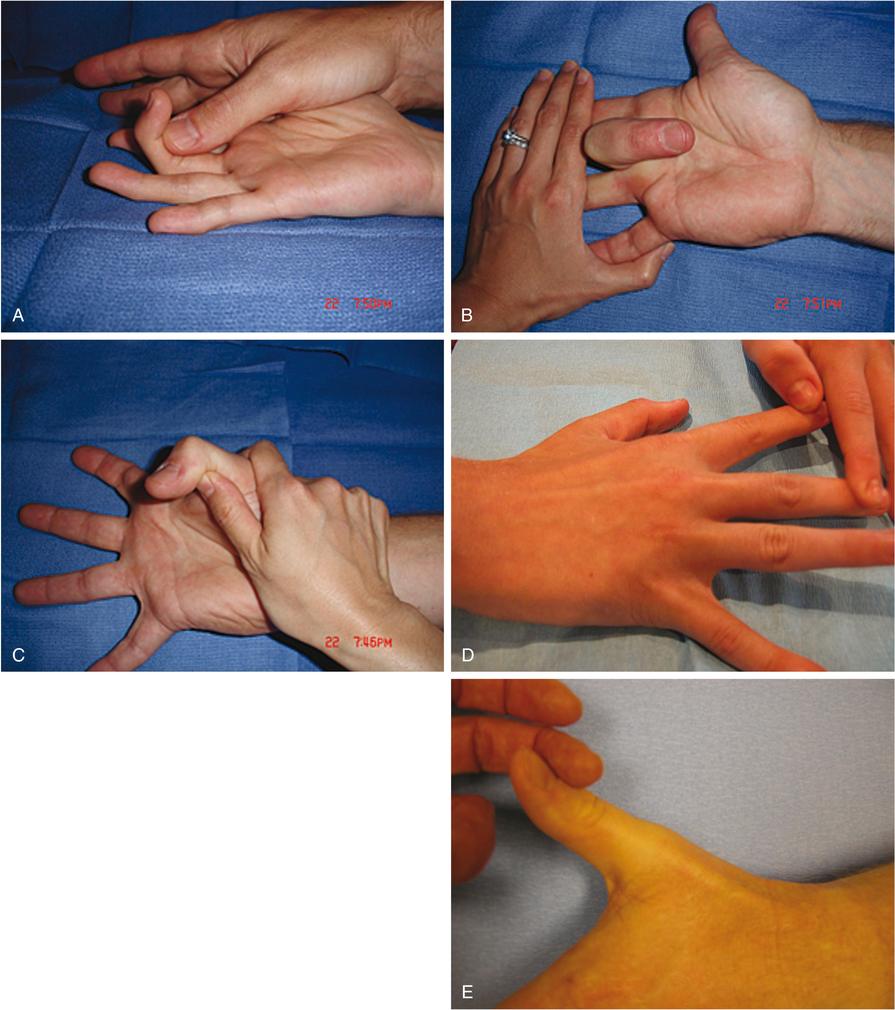 Fig. 70.11, Individual clinical testing of the flexor digitorum profundus (A), flexor digitorum superficialis (B), flexor pollicis longus (C), finger extensors (D), and thumb extensors (E).