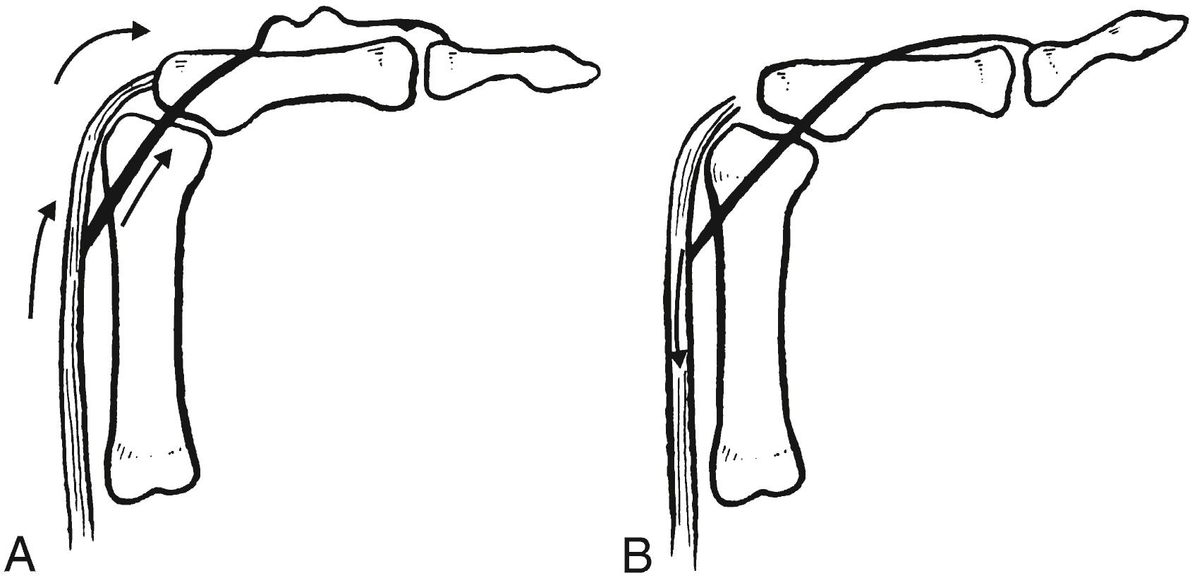 Fig. 70.12, (A) Maximal passive flexion of the proximal interphalangeal (PIP) joint causes slack in the lateral bands because they are pulled distally by their interconnections to the extensor hood proximally as the central slip and extensor tendon are pulled forward. Thus, normally, one cannot actively extend the distal interphalangeal (DIP) joint when the PIP joint is passively flexed. (B) Central slip injury eliminates the lateral band slack that is normally produced by passive PIP joint flexion and allows extensor tension on the DIP joint because of proximal migration of the extensor apparatus. The ability to extend the DIP joint is pathologic.